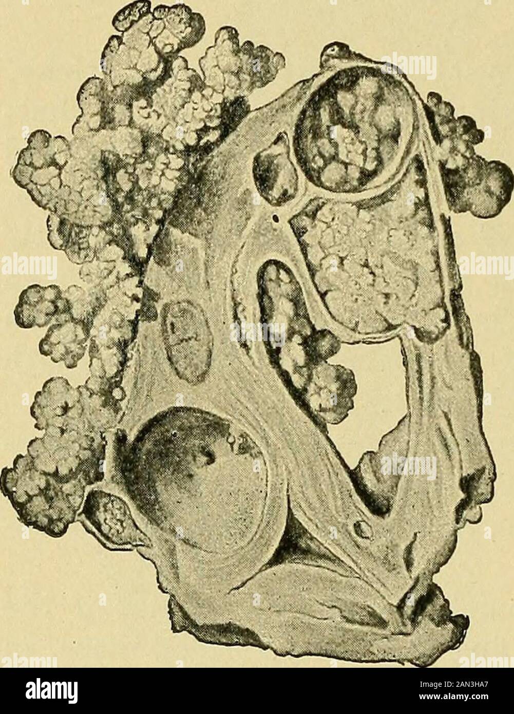 Patologia e trattamento di malattie delle donne escreti simili a y si trovano sulle facce interne delle diverse cavità nelle più svariate fasi di sviluppo nelle diverse porzioni del tumore (vedi figg. 170 e 171). Essi hanno una grande energia di proliferazione, e presto riempire le cavità cisti. Poi perforano la parete e raggiungono la superficie dei tumori, che presto viene completamente coperta con queste eccescenze papillari. In altri casi la forma delle papille può iniziare principalmente sulla superficie del papilloma ovario-Superficiale. Questa formazione di papille sul sur Foto Stock