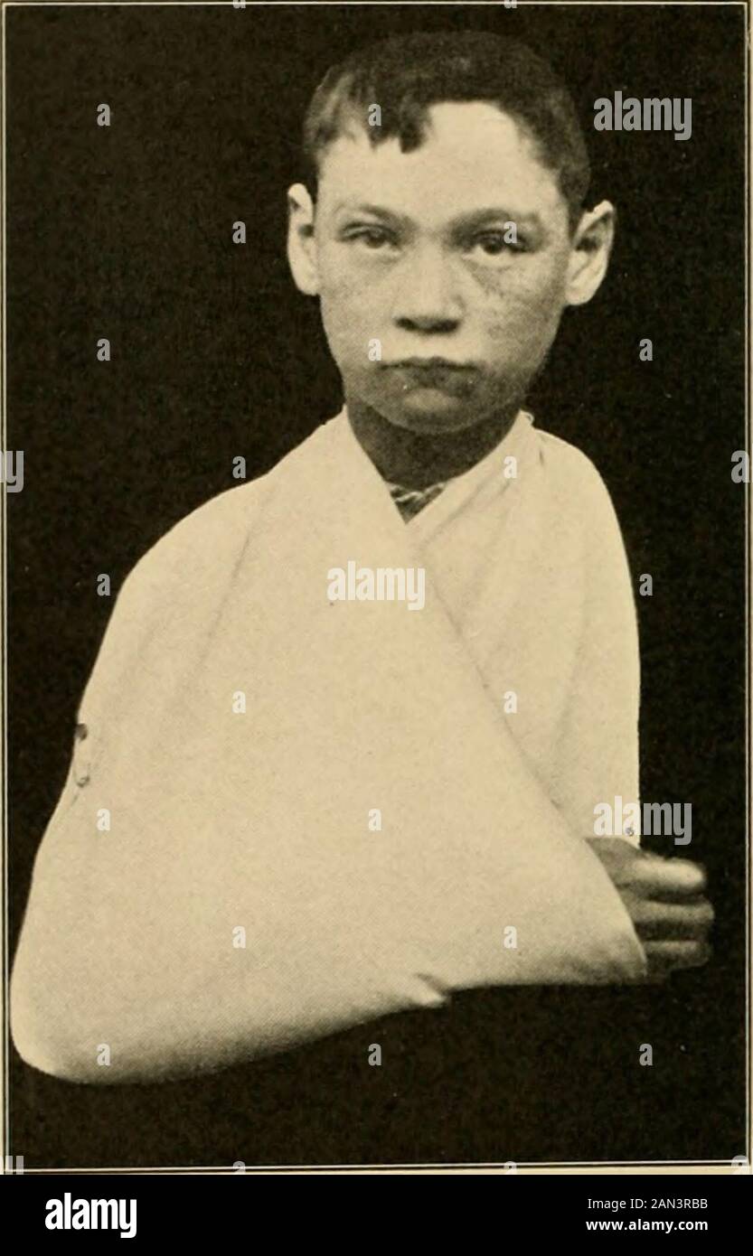 Il trattamento delle fratture . Fig. 267. - applicazione dell'imbragatura. Posizione corretta del bendaggio triangolare nella prima fase. 2 isportato sopra la spalla destra; 1 goccia sopra la spalla sinistra: r e 2 sono fissati dietro il collo; 3 è portato avanti e bloccato, come mostrato in figura 268. unione è detto esistere. Se dopo un periodo di tempo non si verifica più Unione, si dice che la non Unione esiste. Un caso di Unione ritardata può risultare non-Unione o può diventare unita. Il termine nonunionunionnon implica tuttavia necessariamente che nessuna Unione esiste sia tra le ossa, ma semplicemente che l'Unione ossea non esiste. Casi di cosiddetta non Unione Foto Stock