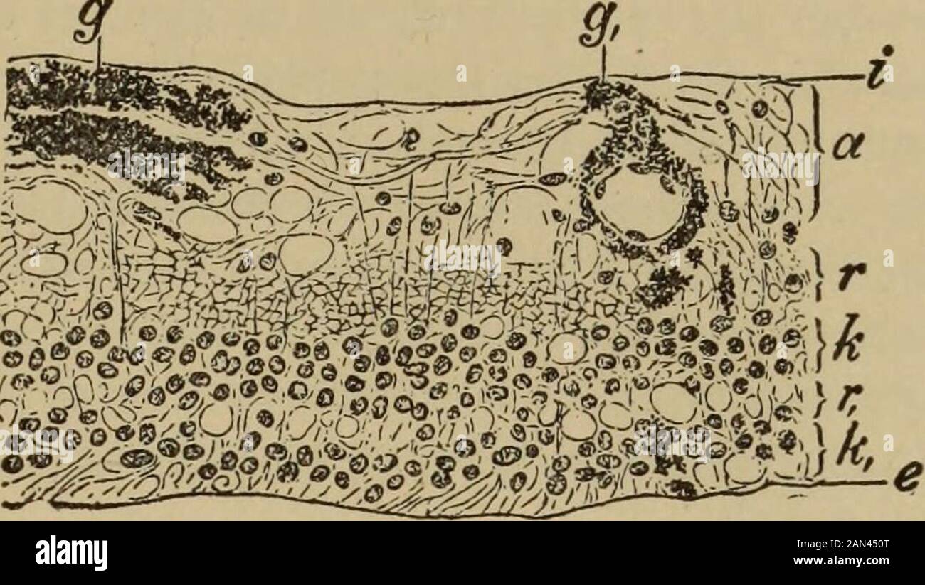Testo-libro di oftalmologia . non è il caso fino a tardi nella vita (nel sessantennio o più tardi). [In alcuni casi di retinite pigmentosa il disturbo principale della vista, specialmente di forreading, è causato da una cataratta corticale. La parte più densa di questa opacitàlenticolare si trova a destra nel centro dell'area pupillare, e quindi questi pazienti vedono il peggio quando l'allievo è contratto, cioè, in una luce forte. Essi costituiscono quindi un'eccezione per le persone therule thai con retinite pigmentosa vedere peggio quando l'illuminazione è ridotta. Questi casi possono essere riconosciuti dal fatto che la dilatazione della pupilla Foto Stock
