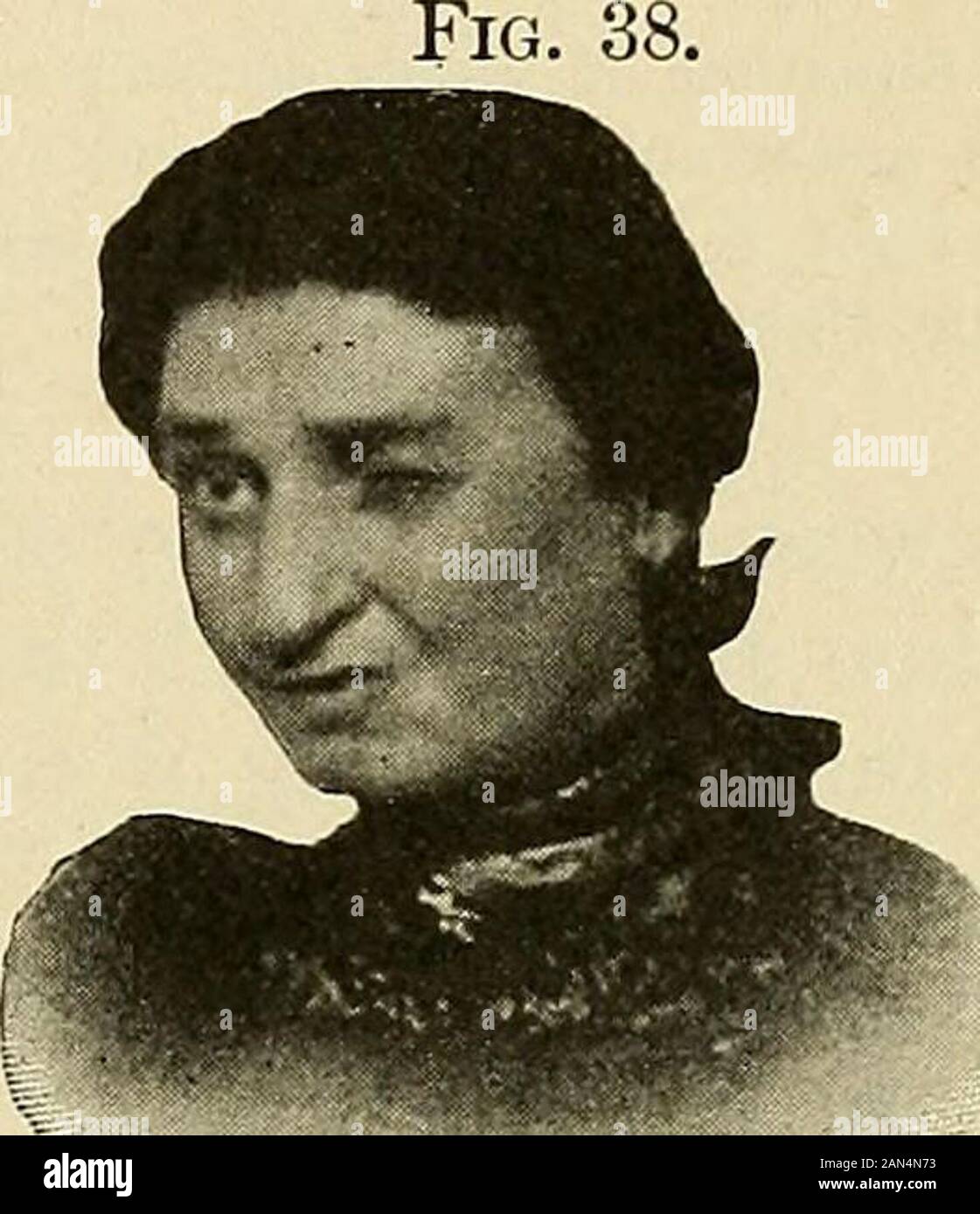 Organico e funzionale di malattie nervose; un libro di testo di neurologia . Situazione di tumore provocando spasmo del andeyes testa a destra; rimosso con successo. Situazione di tumore provocando spasmo dei lati destro viso e lingua ; motore anche afasia. tumore è mostrato che. Spasmo localizzato della faccia in apatient affetti da Jacksonianepilepsy. la spalla. In Fig. 36 La situazione di acaused questa forma di spasmo corticale l'uni-form inizio di Jacksonian epilessia. Contrazioni spasmodiche dei muscleson facciale di un lato indica una irritazione nel lowerthird del motore area ai piedi del Foto Stock