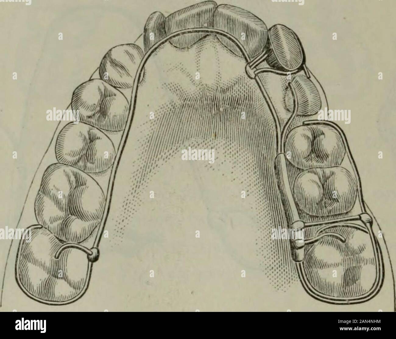 Il cosmo dentale . Thecrown del superiore sinistra canini è di circa un terzo è scoppiata e io8o il cosmo dentale. prossimi all'interno dell'arco, come non vi è spazio sufficiente per eruptin linea corretta. Tutti i denti rimossi e il superiore sinistra in primo luogo molarhad stata estratta da un medico che ha inserito un ebanite platethat coperto il tetto della bocca ed esteso attraverso il spacemade dalla rimozione del primo molare, in modo da formare un fermaglio attorno ilsecondo molare, da cui proiettato un punto metallico sia sul labialand lati linguali del dente, per l'attacco di quattro piedini di gomma ringsw Foto Stock