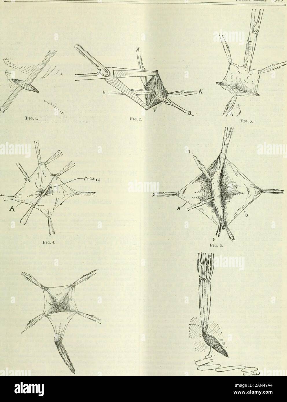 British Medical Journal . vantages di questa operazione come un trattamento-mento nell'ernia dei bambini saranno evidenti. Theprinciples ricordare di rimuovere il sac a thehighest livello possibile con il minimo disturbo oftissue. Il taglio e le interferenze con i tessuti hagbeen ridotto ad un grado tale che verj convales rapido-cenza segue, e reazione di tbe associato herniaoperation è ovviata. I vantaggi di un operationwhich riduce il taglio di tessuti giù per un inchincision in pelle e fascia superficiale e un smallincision nella fascia spermatica, saranno evidenti. N. Foto Stock