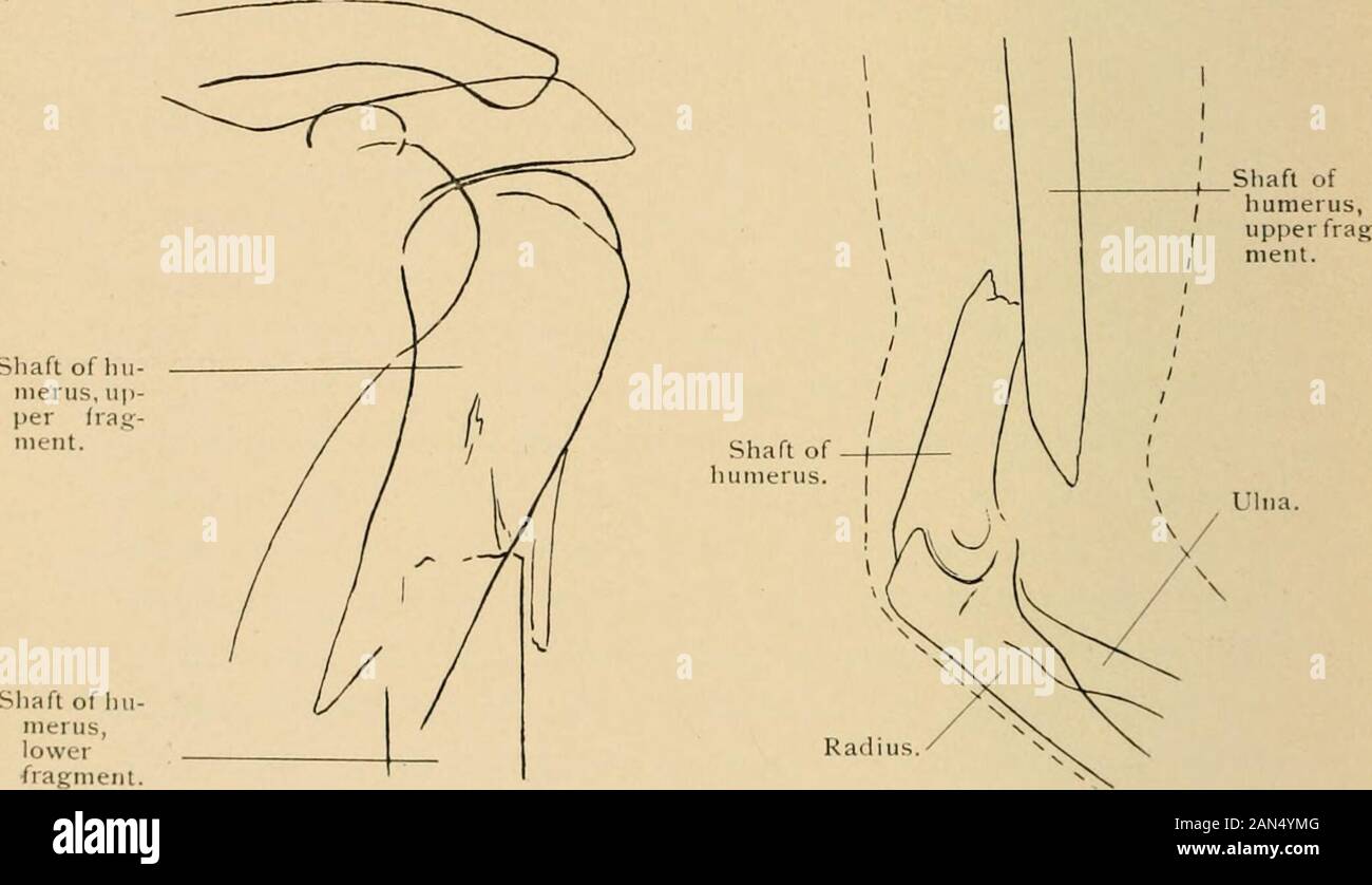 Il trattamento delle fratture . operazione per paura di spostare l'estremità superiore del thehumerus troppo lontano dalla cavità glenoidea. I risultati finali fol-abbassamento di riduzione e di punti di sutura sono stati, come regola, eccellente,bracci utili risultanti nella maggior parte dei casi. I risultati seguenti ex-cision sono solo abbastanza soddisfacente. Se la quantità appropriata di bonehas stato rimosso, anchilosi non si verificherà. Se troppo bonehas stato rimosso, un penzolante o giunto correggiato risulterà. Un ex-cision deve essere evitata se possibile. H4 fratture dell'omero fratture dell'albero del HUMERUSFracture dell'albero dell'omero può Foto Stock