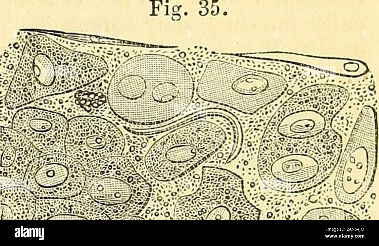 Un sistema di chirurgia : patologico, diagnostico, terapeutico e operativa . Chimica ha mostrato che questo tumore è composto principalmente da chondrine, un pecu-bugiardo forma di gelatiue, in unione con fosfato di calce. La questione animale isreadily estratto mediante ebollizione, e differisce dalla gelatina ordinario principalmente in beingprecipitated da alcuni dei sali di piombo, allume, e ferro. Il tumore cartilaginei è talvolta avvolto da un distinto cisti, compostodal condensato sostanza cellulare; altre volte, è interamente bisognosi di tali acovering, specialmente quando esso proviene dall'interno degli organi. Esso Foto Stock