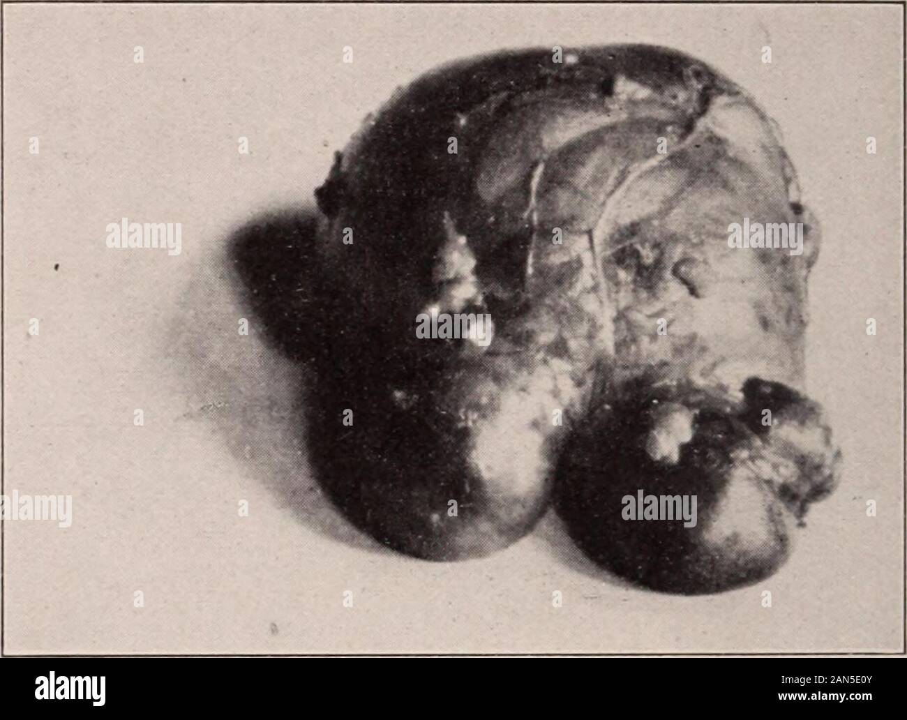 Le transazioni della Associazione americana di ostetrici e ginecologi per l anno ... . A cadere lontano dal bacino towardthe diaframma, e la mia assistente abbiamo suggerito di probablyhad a che fare con una ciste del omento. L'operazione, che è stata fatta attraverso un diritto rectus inci-sion estendentesi dall'ombelico al pubes, rivelato amultilocular cisti dell'omento, con evidente l'impianto30 396 LOUIS FRANK, metastasi, come abbiamo pensato al momento, su tutti il peritonealsurfaces, cieco, piccolo intestino, mesenterica, utero, anteriore andposterior strati degli indirizzi di massima di legamento, e i tubi di un Foto Stock