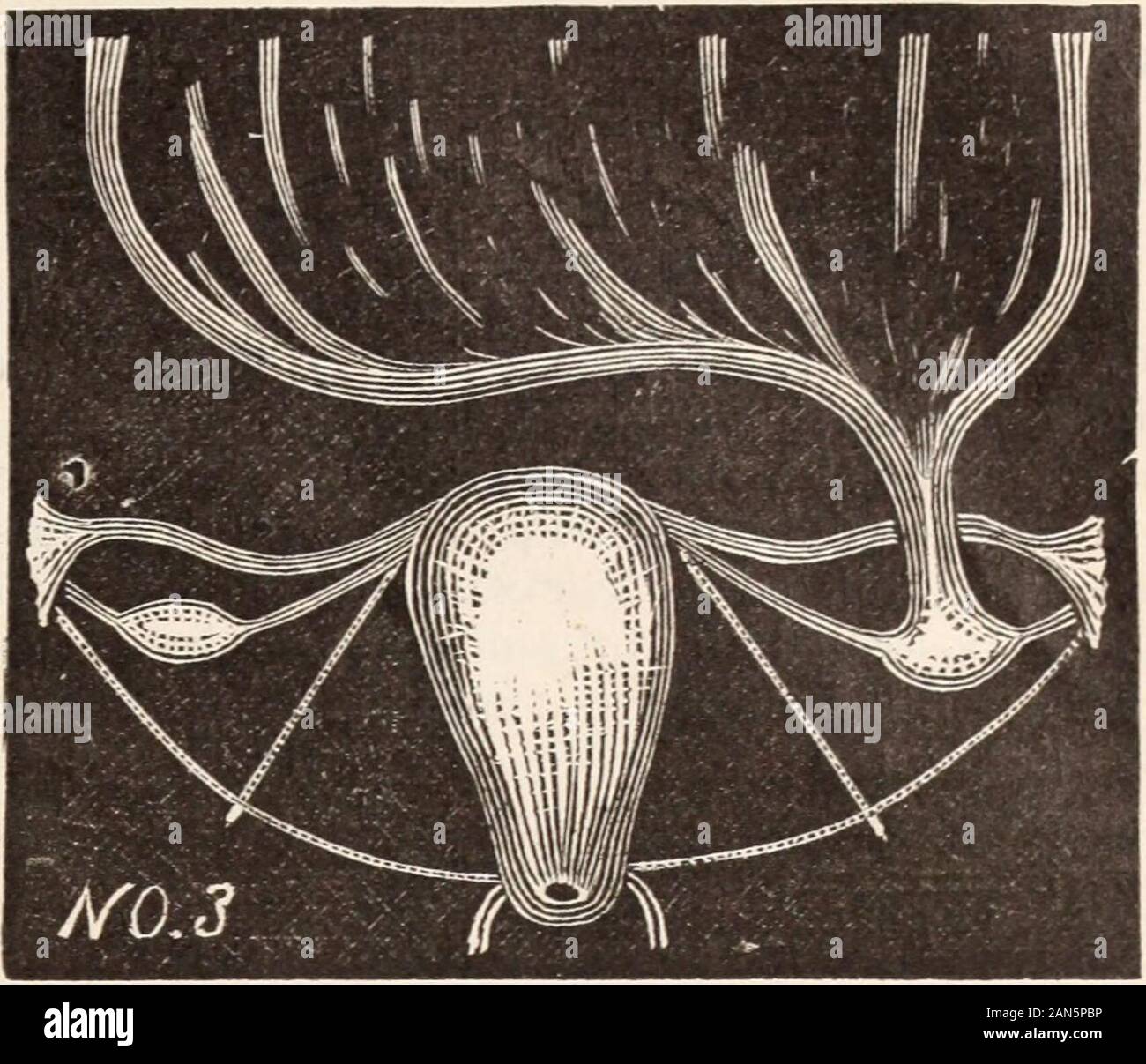 Il medico di età : un semi-rivista mensile di medicina e chirurgia . Schema no. 2 rappresenta le ovaie e tubi rimossi da agirl dai 14 anni, per l'epilessia. Bimanuale ex-amminazione di regione pelvica ha rivelato en-largement delle ovaie. Pressione su ovaie,dall'infanzia, provocò epilessia o hysteri-cal sequestro (zona hysterogene o epileptique, ofCharcot). La sezione di addome realizzato linea inmedian nov. 26th, 1885. Tubi e ovariesthe sede di numerose cisti, come mostrato nello schema.uno dall'ovaia sinistra aveva un peduncolo uno inchand a metà in lunghezza ed era grande come asmall ciliegia. Cisti con sh Foto Stock
