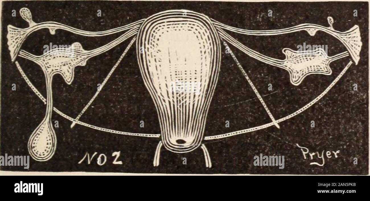 Il medico di età : un semi-rivista mensile di medicina e chirurgia . Schema XO. 1 rappresenta una cisti ovarica che mi removedfrom il corpo di una donna imuden invecchiato 44 anni.Il peduncolo era tre pollici di lunghezza e la cystwas circa le dimensioni di una grossa ciliegia. Ella wasnotoriously isterica. L'altra ovaia wassound, come mostrato nel diagramma. Ella diedfrom dilatazione del cuore.. Schema no. 2 rappresenta le ovaie e tubi rimossi da agirl dai 14 anni, per l'epilessia. Bimanuale ex-amminazione di regione pelvica ha rivelato en-largement delle ovaie. Pressione su ovaie,dall'infanzia, provocò epilepti Foto Stock