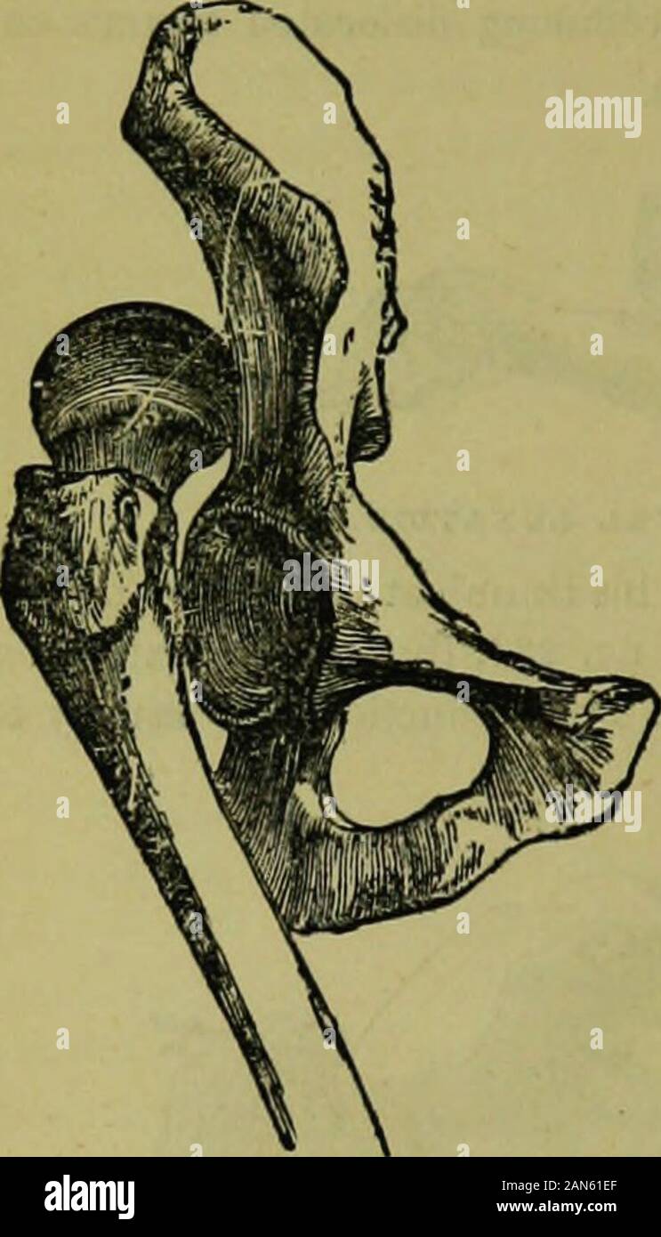 L'enciclopedia idropatici: un sistema di idropatia e igiene .. . 393 3URGEKY l'ileo, figura 236, )r verso il basso, in il foramen ovale, fig. 237. oi Fig. S3G. Fig. S37.. CPWAUD LUXATE f. Fig. 238. Foto Stock