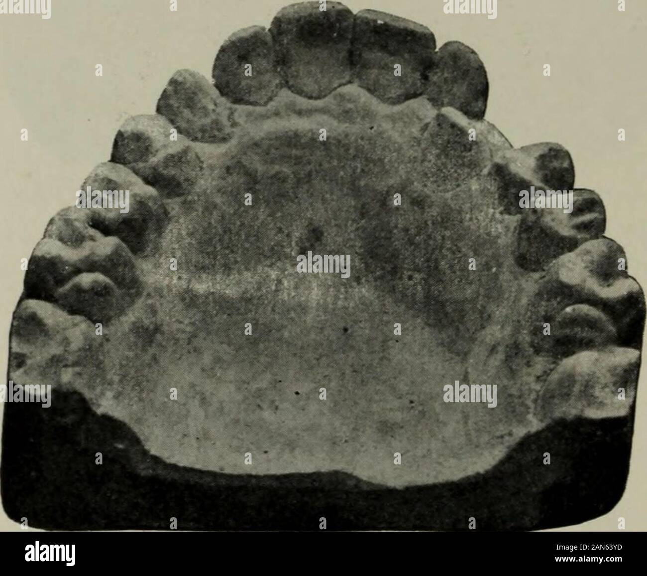 Il cosmo dentale . Fig. C.. lontano una piastra sottile di osso esposta da ri-spostando il tessuto gengivale e vennero directlyto la corona del dente. Il openingwas quindi impaccata per un paio di giorni fino a quando thehemorrhage potrebbe essere controllato, quando asmall foro è stato trivellato la surfaceof la corona che ha presentato verso l'alto-che quando il dente è stato raddrizzato essere-è venuto il disto-superficie approssimale. Foro Intothis è stato incollato un piccolo iridio- gancio al centro da cui un rubberband potesse essere stirato al gancio nel dente. Il risultato è stato interamente satis-fabbrica. Il dente è venuto giù aspromptly come sarebbe stato di sicuro fori imperiali Foto Stock