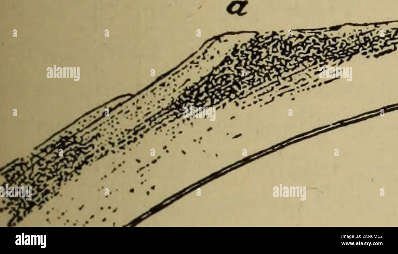 Libro di testo di oftalmologia . r sono gonfi. Il bordo del tappo, extendingbetween le lamelle che sono ancora conservati o, in ogni caso, la infiltrazione surroundingthis frontiera, rimane, apparendo in sezione trasversale di una forma a cuneo in massa di cellule, whoseapex è diretta verso la periferia della cornea (Fig. 97, una e ai). In esso si trovano pneu-mococci che sono ancora in vita e quindi la infiltrazione mantiene insinuarsi fartherand più lungo tra le lamelle della cornea e veloce come si fa in modo che firstlifts e poi si stacca la strati sovrastanti. Questa è la zona marginale di inf Foto Stock