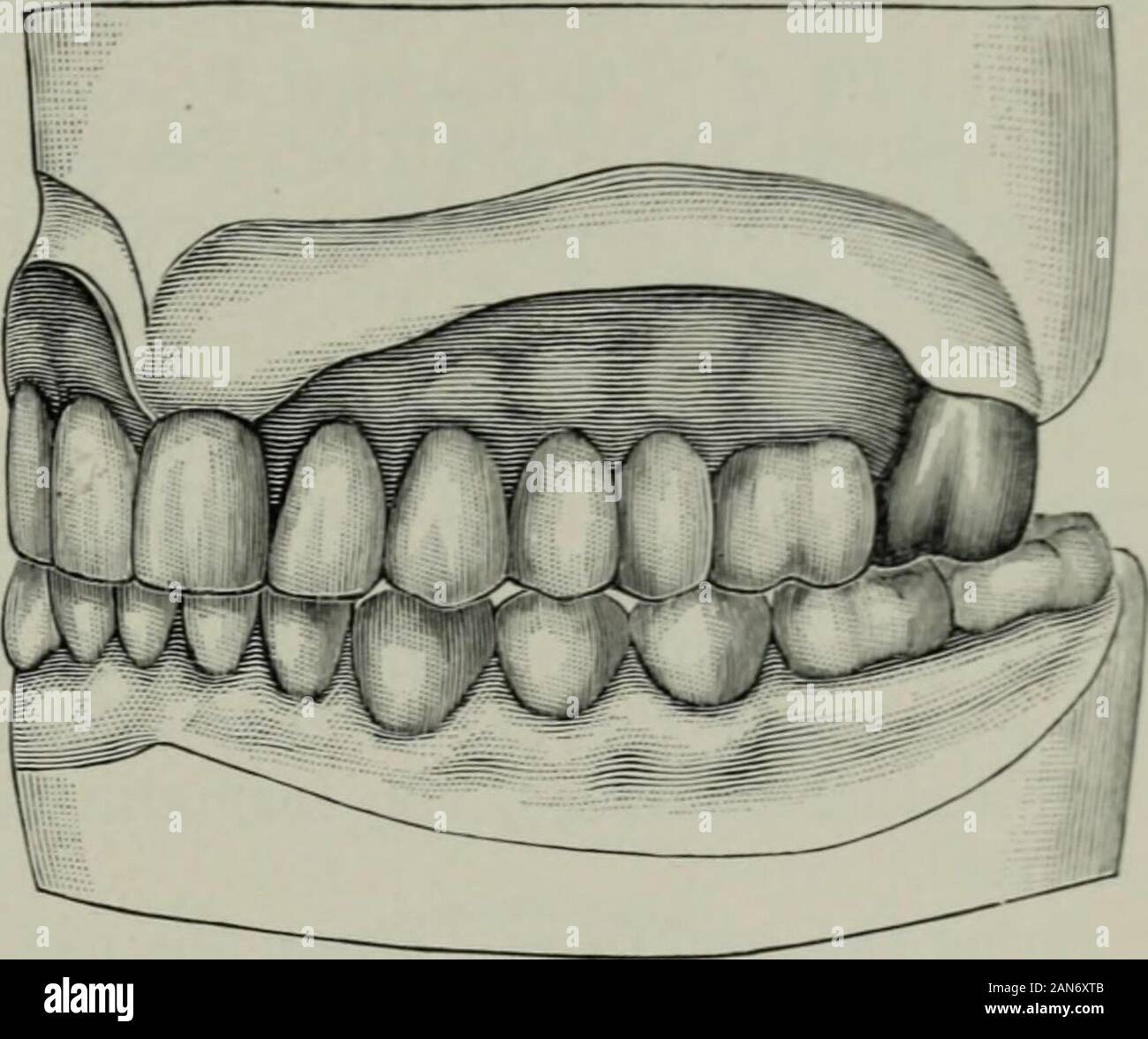 Il cosmo dentale . T, facendo attenzione in sol-dering per ripristinare il contorno del toothas mostrato in Fig. 3, d, d. Questo inserto completesthe riscontri. Quando i riscontri sono realizzati, placethem in posizione con la sella su thecast; cera gli intarsi con perni attachedto sella-utilizzando cera dura di tutti thiswork; rimuoverle dal cast, investire ponti mobili. 157 e saldarli allo stesso tempo solder-ing bitte a sella per il supportodel attacco gomma. Con il pieceso lontano completato, prendere il morso, articu-fine e procedere come nel caso di ordi-nary dentiere. Fig. 4 mostra il wor Foto Stock