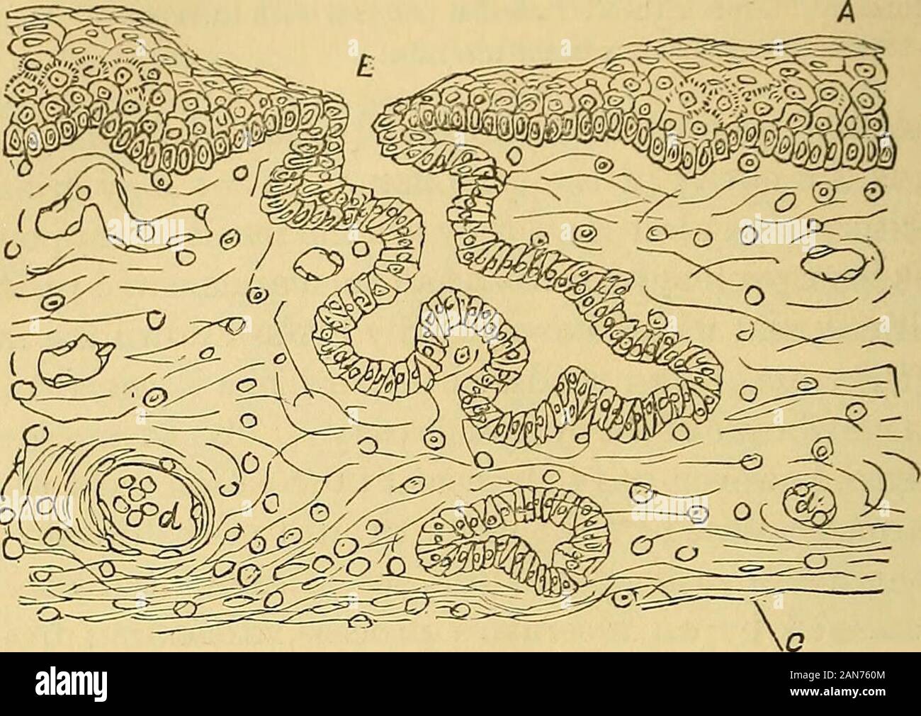 Una pratica Treatise on le malattie dell'orecchio tra cui l'anatomia dell'organo . La sezione di fonetica polipo, caso II. A. epitelio. B. Sostanza di polipo, costituito da una massa di cellule rotonde circa le dimensioni di i globuli bianchi sono. C, C. vasi capillari contenenti i globuli bianchi sono. Caso II.-Mary Jane N., set. 13. Gennaio 10, 1872. Manhattan Eye andEar ospedale. Otite media suppurativa, con polipo in orecchio destro. Riempie Polypusnearly canale uditivo. Scarico da entrambe le orecchie da scarlattina poiché achild. Grandi perforazioni in menibranae tympani. Polipo rimosso withsnare. 392 AUKA Foto Stock