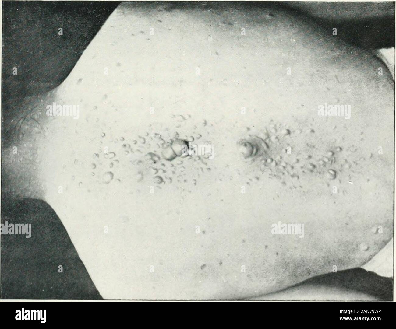 La rivista britannica di dermatologia . X. EPITHELIOMA ADENOIDES CYSTICUM. 387 diventano ulcerata. A un esame ho trovato una ulcerazione infettivo di un benignepithelioma. (Xii) Il Mio Caso successivo che presenta una certa somiglianza con Suttons caso è quella di agirl, 15 anni, che è stato mandato l)y di. Hor.smann McNalib quest'anno, e whopresented vari piccoli tumori sul viso e collo. Per la maggior parte theydid non deve superare le dimensioni di una testa di spine, ma uno che era diventato ulceratedand scabbed sulla destra del coperchio inferiore, aveva le dimensioni di un pisello. Tumori Tlie dei leviti superiori dei coperchi erano appena sollevato al di sopra della superficie Foto Stock