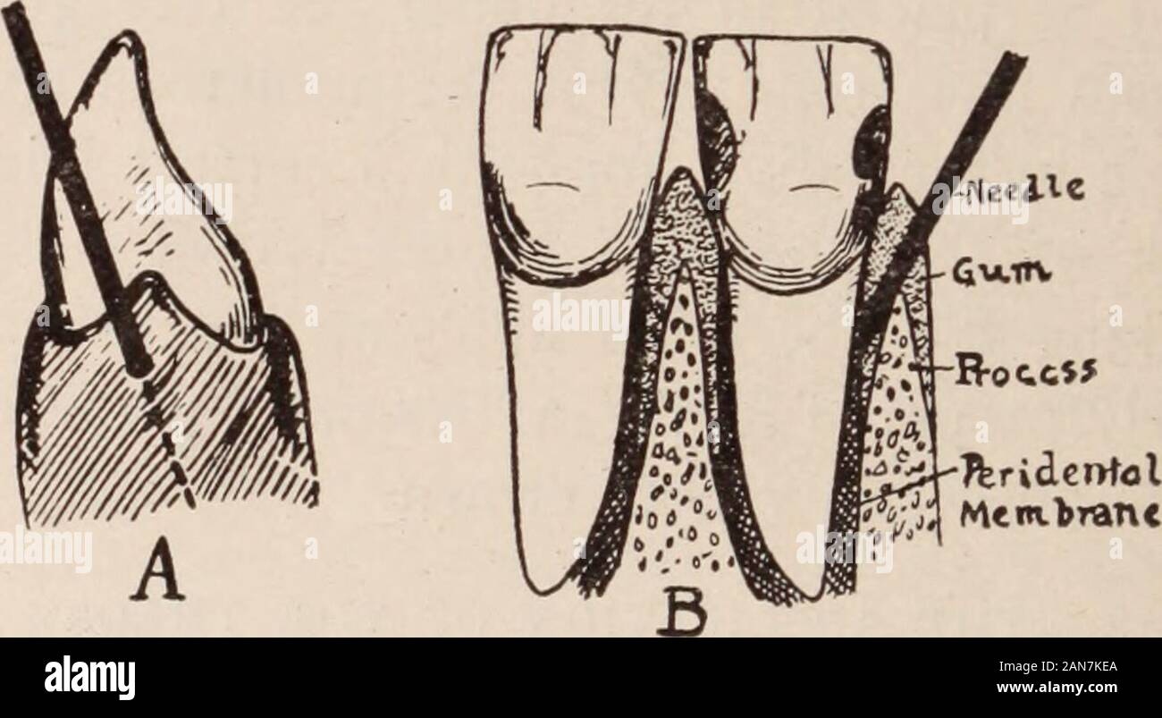 Rassegna dentaria; dedicata alla promozione di odontoiatria. .. Ho avviato il mio ago attraverso il setto di gomma tra i denti, ex- 382 la rassegna dentaria. Premendo una goccia di anestetico qui, quindi dirigere l'needleto un punto dove ho esso lo può forzare ben tra l'alveolo eil radice del dente; e poi, con notevole pressione lastingfrom da cinque a otto minuti, forza il novocain nel tessuto. Caremust essere adottate per sostenere la siringa in modo da non far vibrare esso enoughto rompere il punto dell'ago. Questa operazione viene eseguita utilizzando una restwith la mano sinistra sui denti e aiutando il supporto Foto Stock
