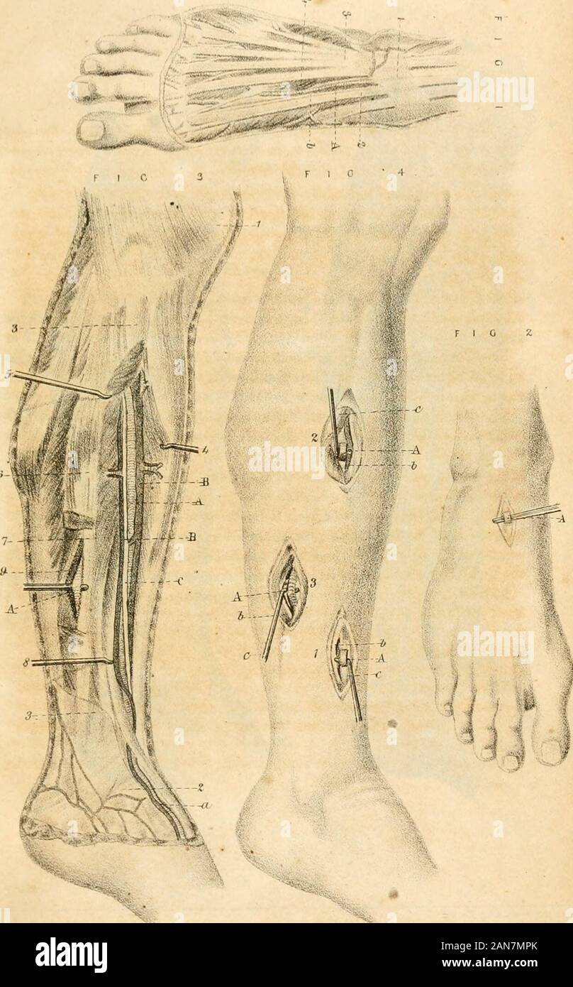 Un manuale di chirurgia militare, per l'uso di chirurghi negli Stati confederati esercito; con piastre esplicativa di tutte le operazioni utili . e malleoli per lo spazio essere-tween alluce ed il secondo dito del piede. Fig. 3.-Relazioni della tibiali anteriore e posteriore le arterie. 4,tibiale anticus muscolo, agganciato in AVANTI ; 5, flessore digitorum communis,tirata verso l'esterno; una anteriore nella arteria tibiale, con B, vena di accompagnamento*giacente profondamente sulla membrana interosseous tra questi muscoli;8,'estensore pollicis pedis assumendo la stessa posizione sul outerside della metà inferiore della sezione anteriore arteria tibiale come il f Foto Stock