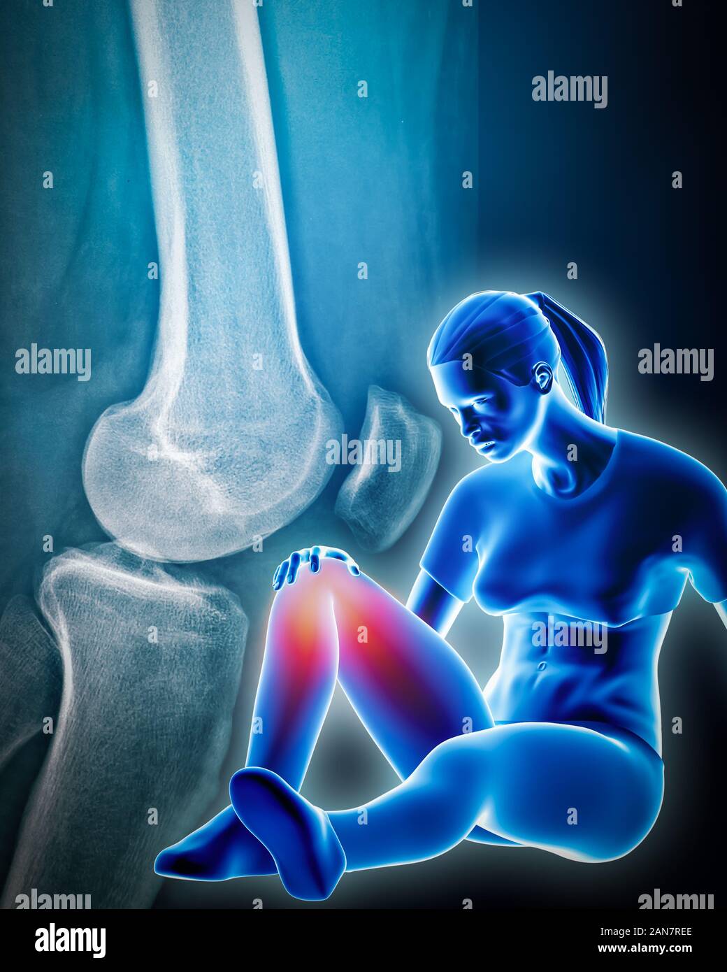 Atletica Giovane donna posa sulla terra tenendo le sue dolorose ferite e ginocchio con ginocchio sinistro x-ray in background. Sport, medico e sanitario, Foto Stock