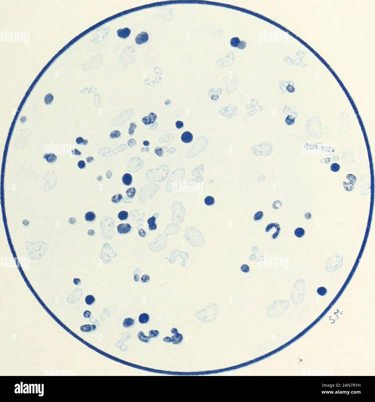 La rivista britannica di dermatologia . Fig. 5.-vista generale.. Fig. ti.-Sezione dalla reticulur parte della pelle,mostrando le spore di funghi. Macchia: Polychromaticmothylene-blu di glicerolo-etlier. Per illustrare il prof. E. BRUUSGAARDS ARTICOLO SU H/EM ATOG ENOUSINFECTION IN TRICHOPHY TIA. HJIMATOGENOUS INFEZIONE IN TRICHOPHYTIA. 157 identico a quello nel fuoco primario sulla pelle. Da ogni unadelle queste infiltrazioni un trichophyton g-ypsenni che la maggior parte nearlycori-esponded al gruppo di un asteroide è stato coltivato su maltosio andglucose agar. Per dirla breve, abbiamo a che fare con un caso di trichophytiaprof Foto Stock
