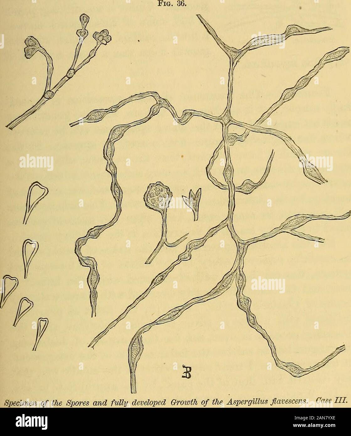 Una pratica Treatise on le malattie dell'orecchio tra cui l'anatomia dell'organo . chiaro da examininga porzione di stampo comune con bassa potenza. Le fibre della pseudo-membrana sono infeconda, ramificata, dritto, orcurved, e spesso alquanto rigonfiati in corrispondenza delle articolazioni. Nel più ampio fiberstransverse cell-pareti sono distinti e tutti, larga e stretta, contengono debolmente plasma granulare. La larghezza del micelio fibre era da 0.00015a 0,0002 di un pollice (0.C038 a 0,005 di un millimetro). Nel frutto-porzione di appoggio si trovano i cambiamenti nella forma che stabilire * American Journal of th Foto Stock