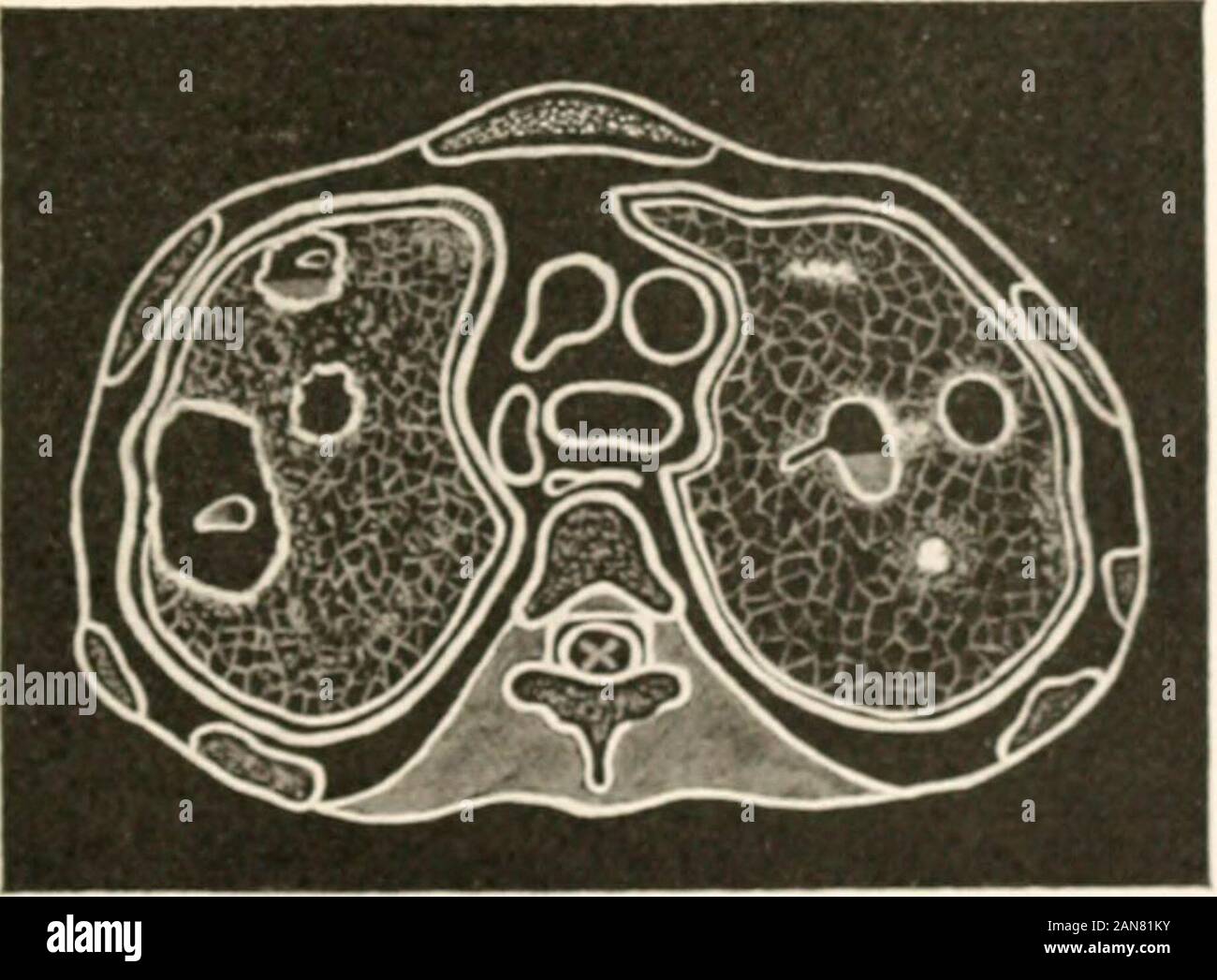 L'esame medico per le assicurazioni sulla vita e i suoi associati metodi clinici : con capitoli su assicurazione della vita declassati e di assicurazione contro gli infortuni . Fig. 62. -Lobar polmonite (sinistra); centrale polmonite (Rigb il consolidamento lobar sul lato destro sarebbe presente il 1 lassie segni olplete solidificazione con il brevetto dei bronchi. ntral ana di consolidamento avrebbe resa non segni di percussione e di essere chieflydenoted da lontano la respirazione tubolare oscurata dalla malattia vescicolare mormorio di..verlving polmone-cellule.. S3.-Vara L'ESAME MEDICO PER LE ASSICURAZIONI SULLA VITA. rispetto al suo compagno, corrispondente a destra Foto Stock