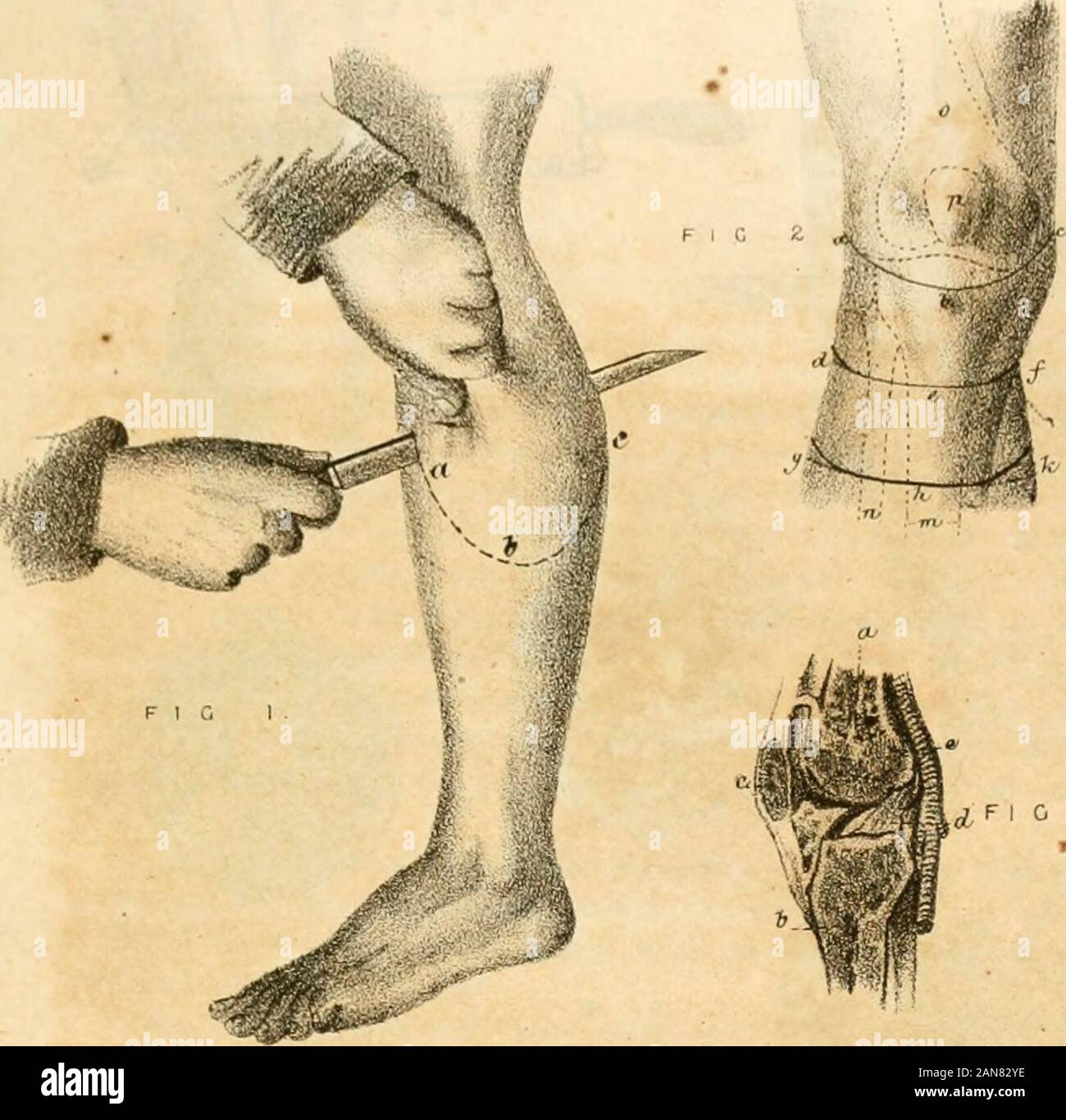 Un manuale di chirurgia militare, per l'uso di chirurghi negli Stati confederati esercito; con piastre esplicativa di tutte le operazioni utili . ampio lembo posteriore, asin fig. 1; abc, incisione anteriore per una disarticolazione a ginocchio-giunto, comesi vede qui in fig. 4. Fig. 3.-anatomia del ginocchio-giunto, un, estremità inferiore del femore ; b,testa della tibia; c, patella avvolto nel legamento anteriore o tendonof quadruceps il muscolo estensore, chiamato ligamentum rotule ; d,legamenti cruciale; e, Arteria poplitea, giacendo immediatamente su andbehind giunto. Fig. 4.-l'amputazione in corrispondenza a ginocchio dal lembo posteriore. Il operationc Foto Stock