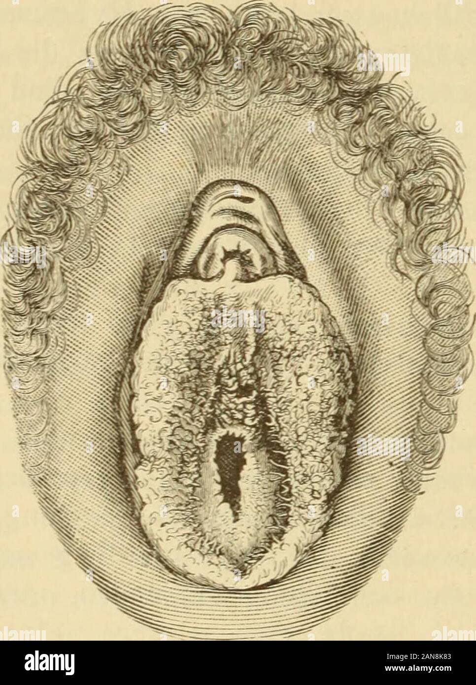 Real-Encyclopädie der gesammten Heilkunde; medicinisch-chirurgisches Handwörterbuch für Praktische Ärzte . ch un derMucosa der Scheide zu ergeben pflegen. Meist sind sie, namentlich an der äusserenWand, così wenig ausgebildet, dass die Schleimhautfläche ein glattes Aussehen besitzt,in anderen Fällen sind die Papillen gerade am imene ungewöhnlich stark ent-wickelt und besitzen ein fimbrienartiges Aussehen, welches namentlich am freienRande der Hymenfalte auffällt (Imene fimbriatus). Die Unterfläche der imene-falte hebt sich in der Regel gleichmässig von der Wand des Vestibulums ab,seltener lassen Foto Stock