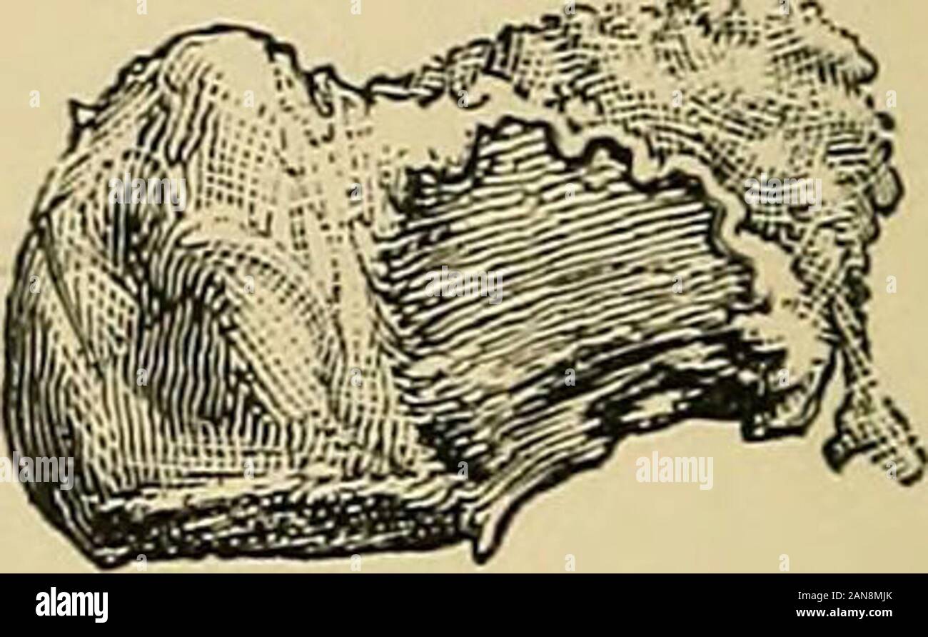 Hip malattia dell'infanzia : con speciale riferimento al suo trattamento mediante escissione . ,^io:&gt;-. C'è la malattia su entrambi i lati del epiphysialline. Sulla superficie inferiore del collo isthe ruvida depressione causata dal pressureagainst il bordo dell'acetabolo. Therewas dislocazione patologico. Thomas F.D., caso 79. L'acetabolo in modo irregolare con uno spot. Molto simile a quella della Fig. 6. La cartilagine marginale ispersistent. Una cavità contenente un seques-trum è indistintamente visto nel calcarfemoris. Un tag di allenti la cartilagine è seenhanging dalla parte inferiore della testa.Herbert, B., caso 71. Acetabolo necrosed. Foto Stock