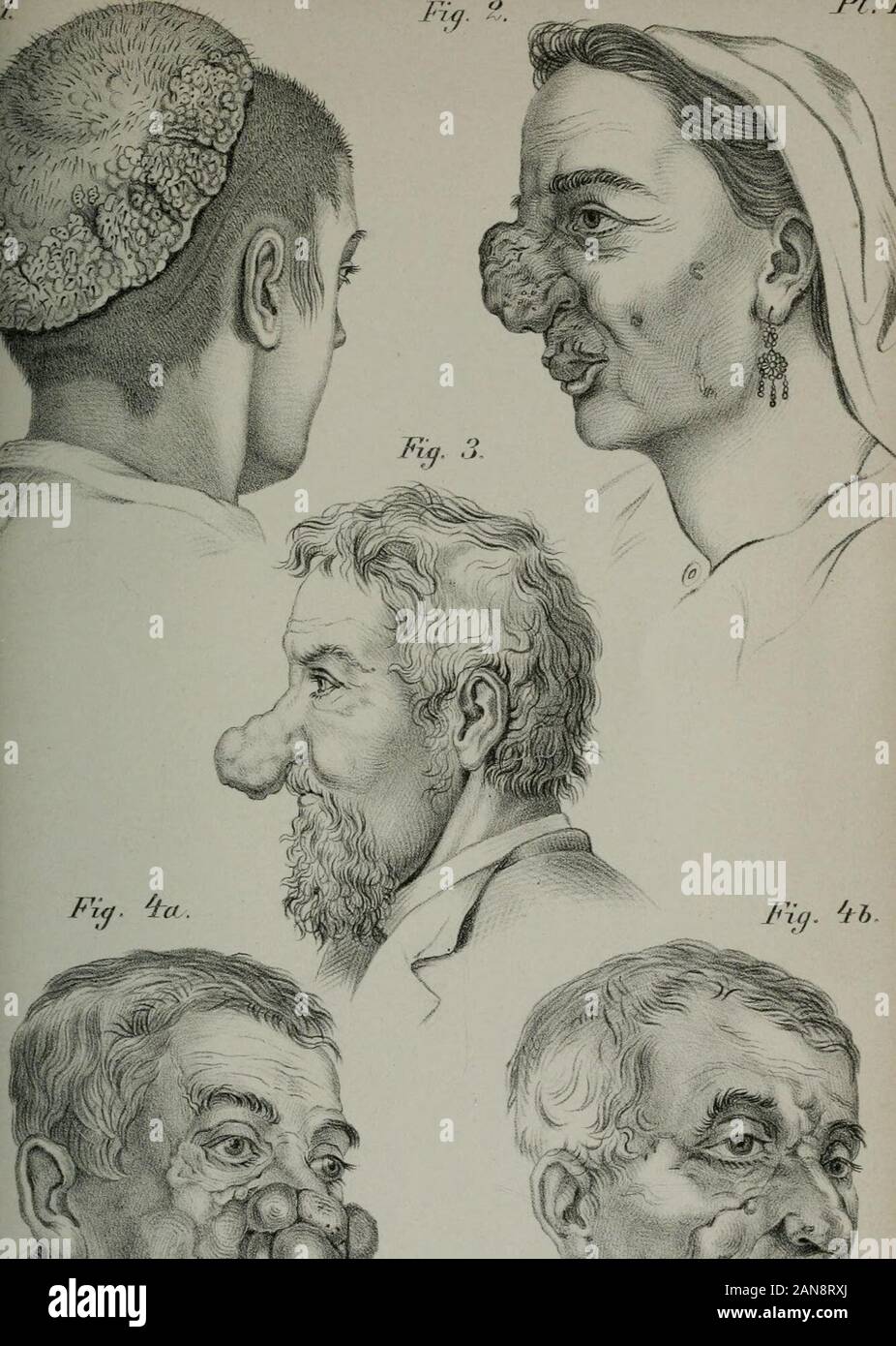 Clinical surgeryExtracts dalle relazioni di pratica chirurgica tra gli anni 1860-1876tradotto dall'originale e modificato con annotazioni, da CTDent . stesso dal di sopra. Om. Piccolo omento. S. sonda. Piastra in. Fig. I.-incisioni per la resezione dello stomaco nel caso di i. Una parte del lume dello stomaco non ancora chiuse. L L L, Lembei-ts sutm intestinale-es.(cfr. pagg. 498, 503-) Fig. 2.-dallo stesso caso, dopo l'inserimento di tutte le suture. (Seepp. 498, 503). Le figg. 3 e 4.-Eesection dello stomaco in caso 2. La vei-tical incisionsthrough stomaco e duodeno. N, occlusione suture, l l l Foto Stock
