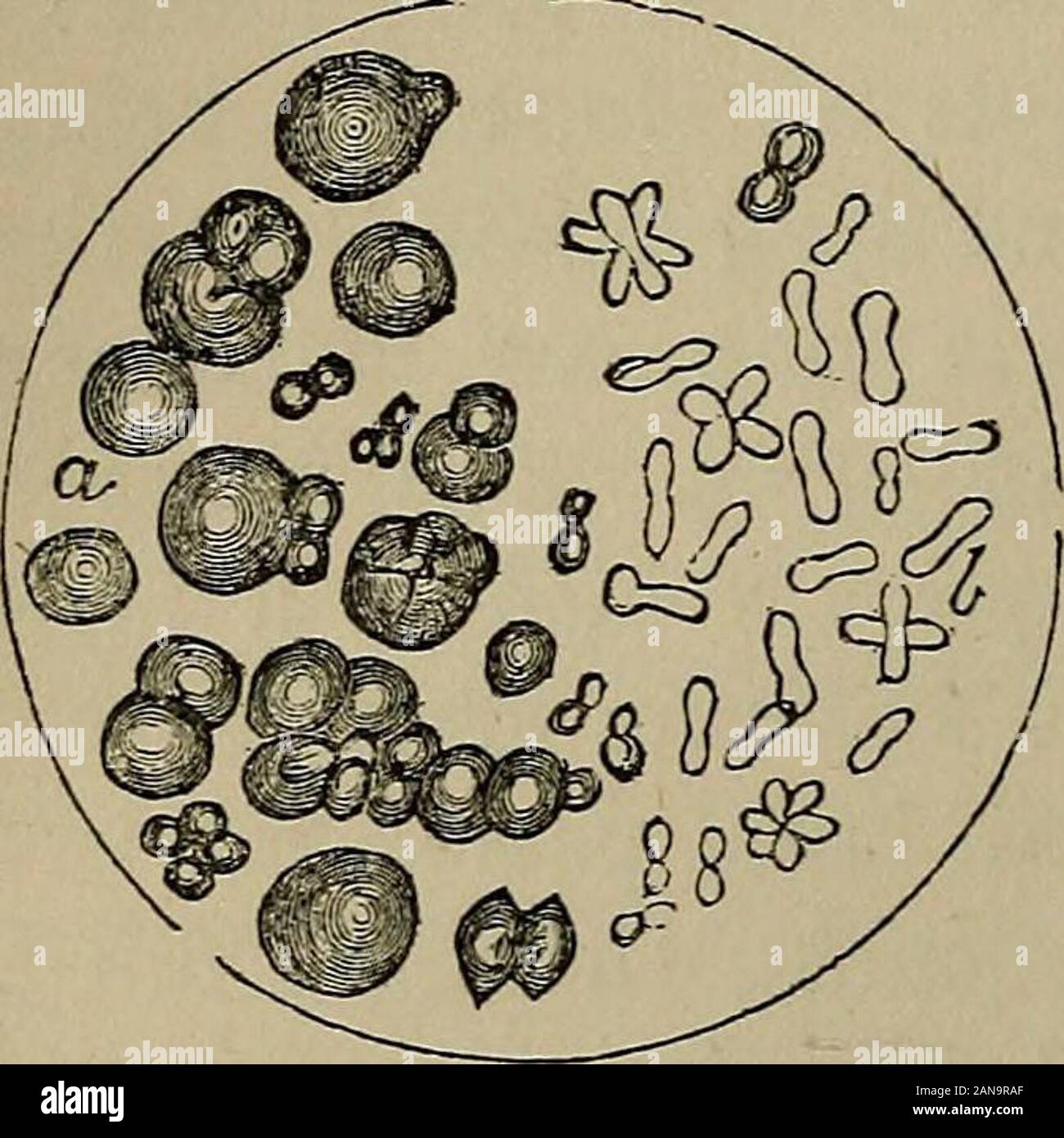 Una pratica Treatise on urinario e malattie renali : inclusi depositi urinaria . che sono necessariamente depositato underthose circostanze. La urato di ammoniaca è di solito adense colore bianco; ma ho conosciuto possiede una tonalità beautifulviolet. Due forme sono visibili sotto il microscopio. La maggior parte com-mon sono sfere e masse globulari,che appaiono quasi nero da trans-mitted luce, a causa della loro opacità(vedi Fig. 11. a). Queste sfere areeasily ottenuto lasciando un urinecontaining amorfo tostand urato in aria fino a che non becomesammoniacal. La seconda forma (u)si verifica come molto minute slende Foto Stock