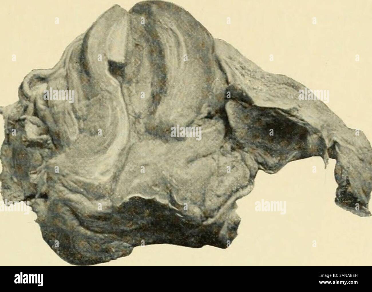 Un libro di testo di ostetricia . rs che non vi è alcun decidua reflexa in gravidanze tubarica,ma Winckel ha dimostrato di essere in due volte. La facile gestione di applicazioni multiple di thetubal mucose sono distesi come il tubo si espande. Ci può essere di più (twin triplet di E2) extra-uterine gesta tion ; coincidente intra- e gravidanza extrauterina ; pregnancyfirst in un tubo e poi nell'altro ; pregnanciesin simultanea di entrambi i tubi ; o due gravidanze successive nello stesso tubo.3 1 Ross, Am. Jour. Obstet., Ottobre 1895. Secondo Heckers statisticsof 45 casi si è verificata rottura 26 volte nei primi due mesi, II tempo Foto Stock