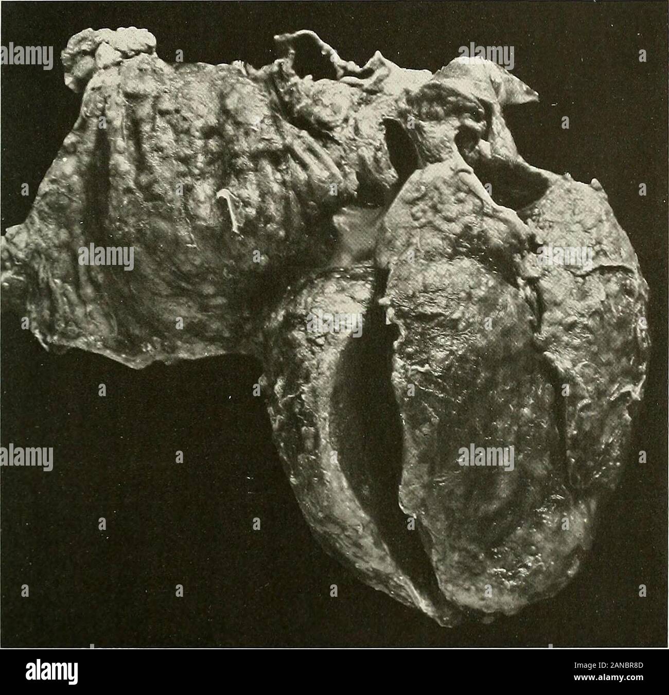 Studi di patologia cardiaca . des, che sono tutti molto ferma e mai umbilicated. Essi non invadere la myocar-dium, che è ferma e scuro di colore marrone-rossastro. Il tessuto tra i noduli darkpurplish è di colore rosso e viene visualizzata per contenere le emorragie. Non ci sono i noduli sulla porzione theexternal del pericardio viscerale. Il ventricolo sinistro Misura 1.5 cm. di spessore.Il cuore è alquanto ingrandita; le cavità sono di buone dimensioni e tutte le valvole sono sottili anddelicate. L'esame microscopico: No especial modifiche sono annotate nel miocardio. Thepericardium è sede di exten Foto Stock