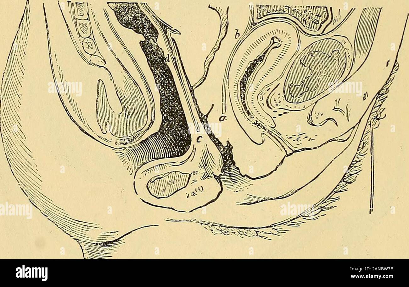 Manuale di ginecologia . e feto umano. Perciò, se il pavimento pelvico di una donna di essere visualizzati sul suo aspetto peritoneale, il Fundus ofVol. I.-3 34 MANUALE DI GINECOLOGIA. la vescica vuota sarà trovato per essere quasi sempre di grandi dimensioni e il controbattitore,mentre in alcuni casi si tratta di piccole e convessa. Nel primo caso il innersurface del segmento superiore della vescica, grandi nell'area, è in contattocon la superficie del segmento inferiore; in quest'ultimo, l'anteriore e pos-terior pareti interne, piccole in area, toccare uno con l'altro. È probabile che quando la vescica ha la forma a Y sulla sezione isin diastole (Fig. Foto Stock