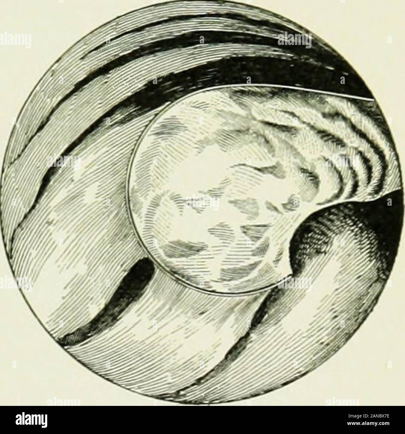 Un sistema di electrotherapeutics come insegnato dalla corrispondenza internazionale scuole, Scranton, Pa.. . L'UCE una lunga e stretta, pezzo di nastro sterile o una garza attraversoil bocca e lungo il pavimento nasale e legare la extremitiesat il labbro superiore. Questo contiene il palato molle e ugola wellforward e in modo che non sia di intralcio. Sotto illuminazione stabile placethe rhinoscopic specchietto nella posizione e tenerlo premuto mentre thecold elettrocauterizzazione-laccio è introdotto nel passaggio nasale del § 18 l'occhio, orecchio, naso e gola 81 un lato-lato per essere azionato a. Per mezzo del imagein lo specchio (vedere Fig. 54) Foto Stock