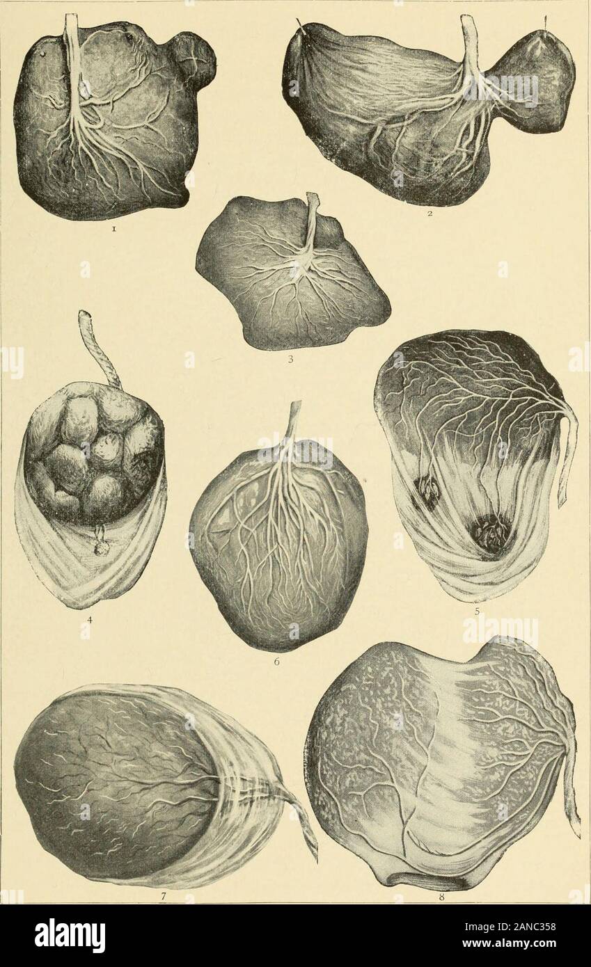 Un libro di testo di ostetricia . e in diretta communicationwith sangue-seni della decidua vera. Dovrebbe villi queste crescite accessorio non comunica con il maternalblood, le crescite sono chiamati placentae spuriae. Taurin x hasreported un caso di placenta anulare, che si estende quasi completamente j^W- ,^ r*T.  • ? &Gt; ifcfci . . -Vt -• B ?H i v^*- llk&LT; • 1 s ^^flj maiale. 91.-Placentae di triplette. intorno all'ovulo come accade in alcuni animali, ma separati indis-tinctly in tre lobi. Edema della placenta.-A infiltrazioni sierose dell'wholeplacenta è spesso osservata con un morto e m Foto Stock