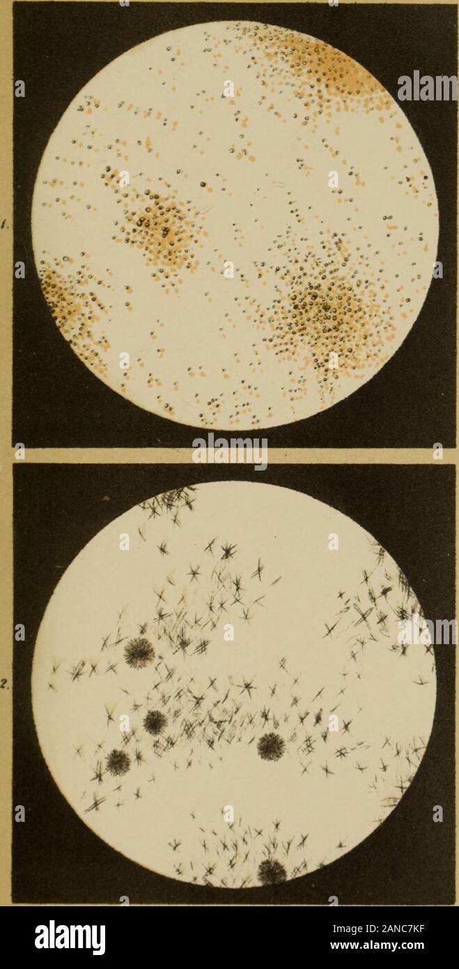 Atlas der physiologischen und pathologischen Harnsedimente . rn.Btfinwiiih V. V"rtaf .ti u. ?? **. -1 X. Tafel. I. Bild. Körniges harnsaures Natron-Amnion= C- Ho Na (NH4) N4 O3 aus dem Sedimente eines Fieber-kranken bei reazione neutraler des Harnes. IL Bild. Künstliches h a r n s u r e s am m o n= G5 H3 (NH4) N4 O3 = G^^^ H3 N^ 0" (NH^). Es wird dar-gestellt, indem uomo Ammoniak mit überschüssiger Harn-säure koclit, filtrirt und das Filtrat bis zur Krj stallisationeindampft. Das stellt sedimenti feine Nadeln dar, welchetheils unter verschiedenen/Winkeln quer übereinandergeworfen sind, tlieils Foto Stock