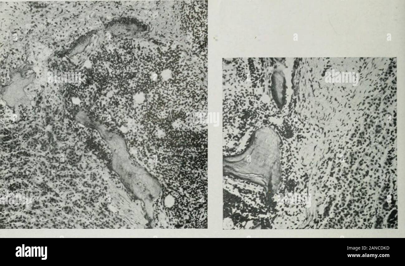 Gazzetta del laboratorio e medicina clinica . andmarked con linee indistinto di congestione. Ci sono state le piccole etichette di vecchi adhesionsupon la sua superficie, specialmente sulla destra llic. Sparse qua e là sotto il capsulewere piccole zone arrotondate che assomigliava a piccole tul)erclcs. Ci sono stati altri di thesewitliin la sostanza dell'organo. La superficie di taglio è stato umido, grigio e irregolarmente mot-tled. Vi è stata una grande angioma nel lobo destro (1x1,5 cm.). Piastrella dotti biliari werepatent e tiicre non erano calcoli biliari. Vi erano vecchie adesioni tra il fiele bladderand gastro-coliche omento. Foto Stock
