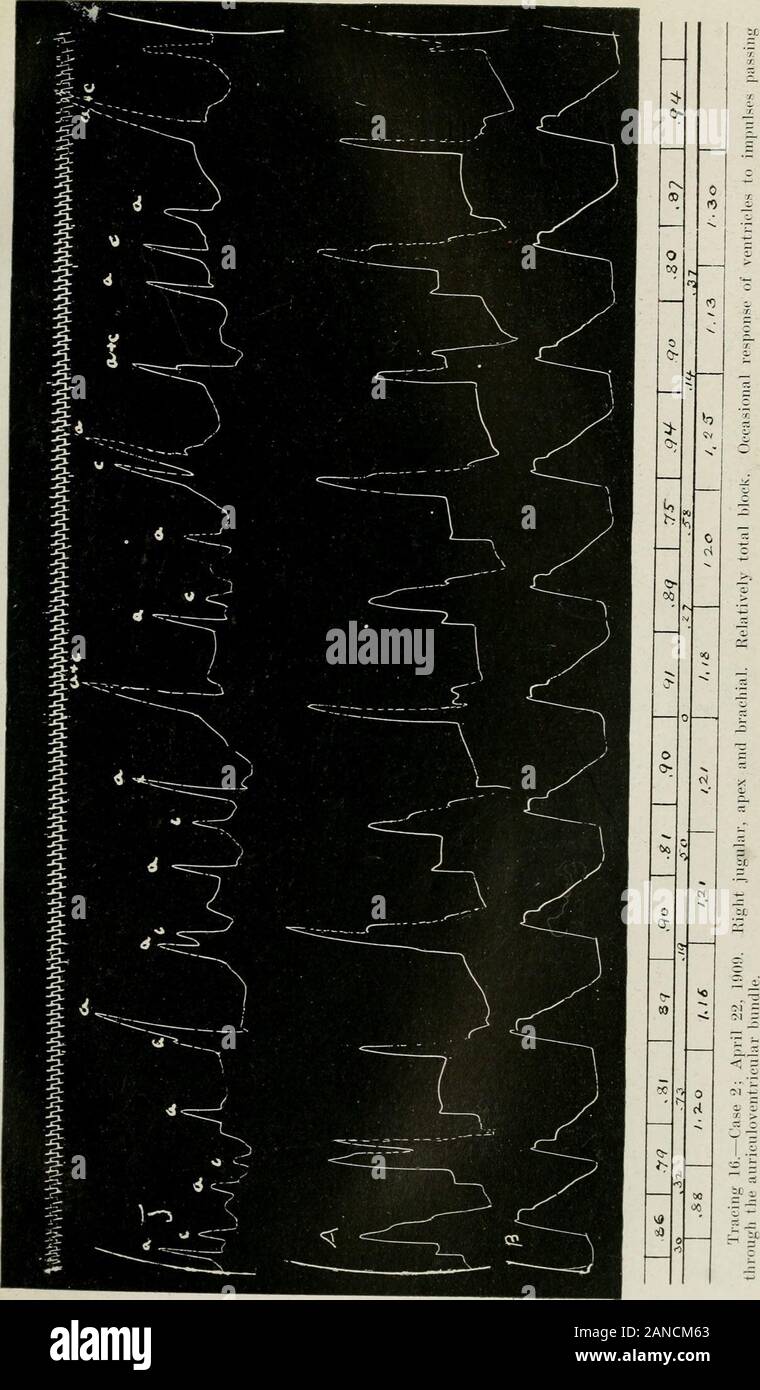 Archivi di medicina interna . 322 ARCHIVIATI I DEI MEDICI IMERXAL XE un rallentamento sia di auricolare ventricolare aud rli sottile senza prolongationof l'a-c tempo. Durante il periodo della pressione, dopo il primo completeintermission vi erano saltuario blocco extrasystoles auricolare. Thecase era uno di arteriosclerosi e miocardite cronica. In tutti questi casi la maggior parte ipotesi ragionevole per la Gxplanationof ventricolari gli intervalli sembra essere quello di un diminishedirritability dei ventricoli e in tutto ci sono state evidenti difetti cardiaci.L'autopsia dei ma uno di questi caso Foto Stock