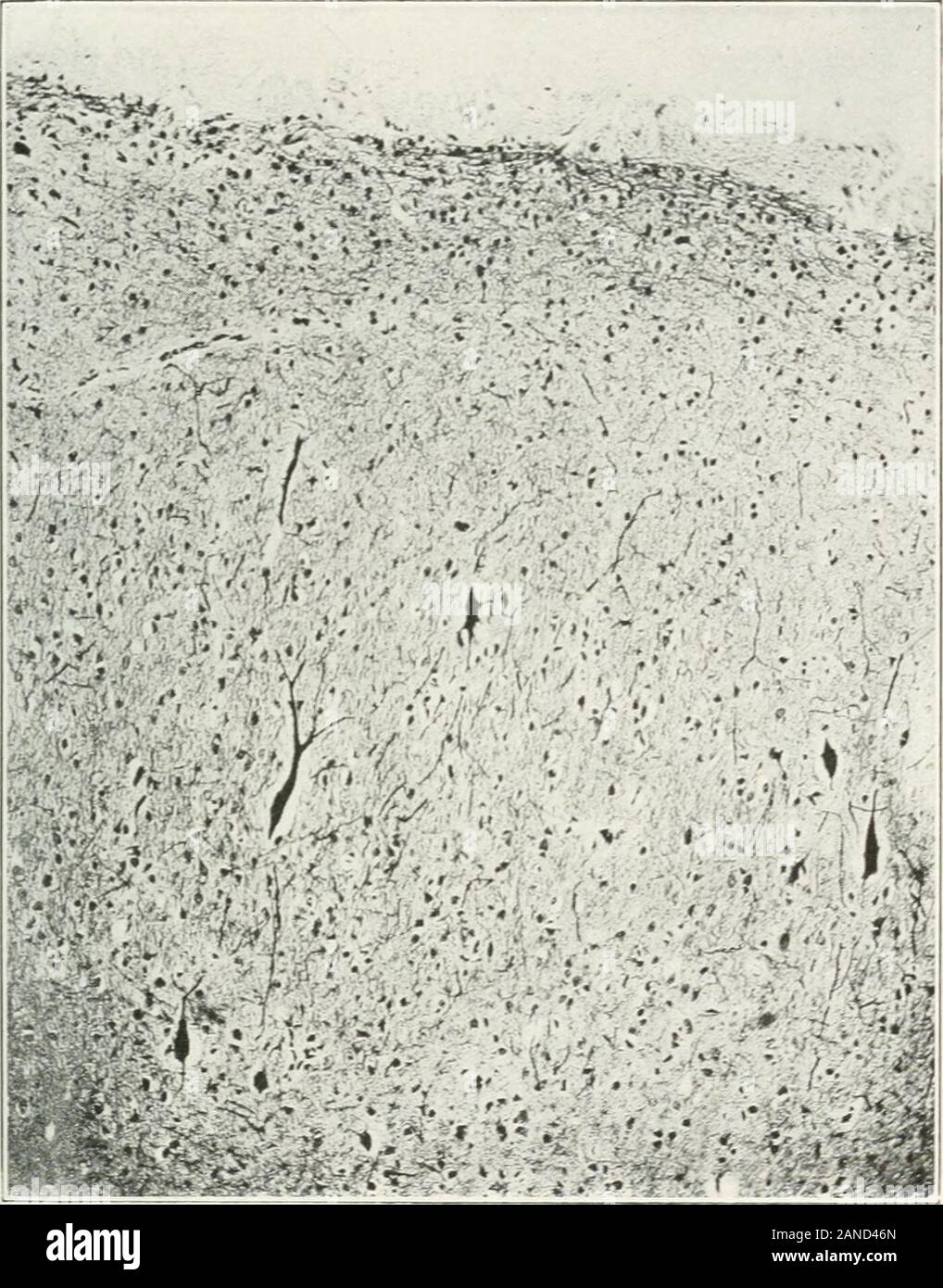 AMAarchives di Neurologia e psichiatria . ^R 5c ^ = y^ ^ &LT;IJ 1- u^ c x s - " FREEMAX-sclerosi tuberosa 623 neuroglia cellule. Bielschowsky indica la loro origine neuroblastic bypointing gradazioni fuori dai normali cellule nervose di round undifferen-tiated quelli su un lato e quelle snakelike sull'altro. Theirstaining reazioni e la presenza di neurofibrillae come dimostrato byAlzheimer indicano anche questa origine.. Fig. 5. ^ low-power view della corteccia sclerotica che mostra il margine neuroglia,esterna dello strato del granulo e atipico di cellule di grandi dimensioni. Argento macchia di diffusione. Mentre queste cellule di solito si è verificato Foto Stock