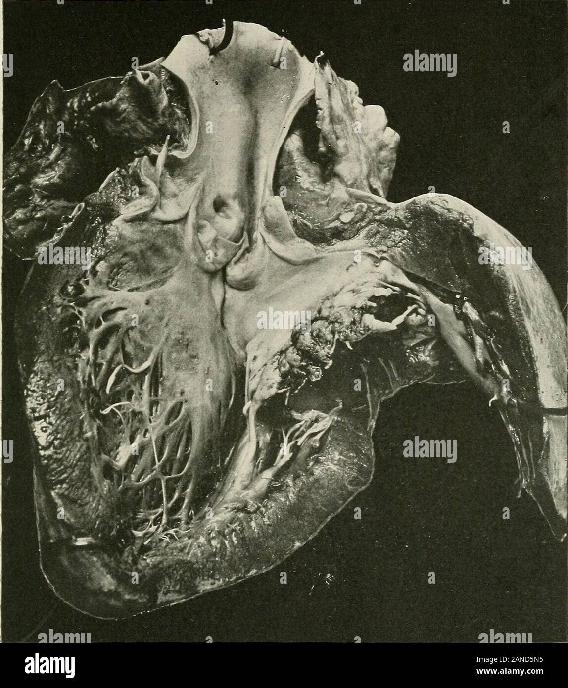 Malattie del torace e i principi di fisica diagnosi . wollen,ulcerata e di colorazione giallastra (Adami e Nicholls). In alcuni casi l'infezione potrebbe diffondersi alla parete del heartwhere cambiamenti simili si verificano in murale endocardio (vedere Fig. 395). Le culture prese dalle ulcere o vegetazioni mostreranno grandi numbersof microrganismi che sono spesso estremamente virulento. Un histologicalexamination dell'area interessata mostrerà anche innumerevoli batteri. Secondo Horder una cultura di un organismo patogeno può essere ob-tained nel novanta per cento dei casi di endocardite infettiva. In addit Foto Stock