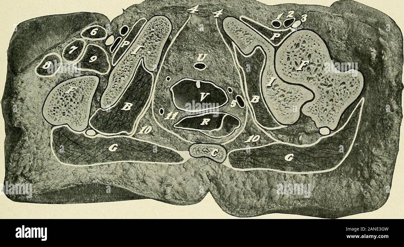 Un libro di testo di anatomia clinica : per studenti e professionisti del settore . Fig. 88.-sezione del bacino a livello delle articolazioni sacro-iliache. S, sacrum. Ho, ileo.SC, colon iliaca (flessura sigmoidea). C, cieco e inizio del colon ascendente, i,poste sul lato interno di ciascuna articolazione sacro-iliaca. 2, ureteri. 3, Mesosigmoid, mostrando greatlength di quest'ultima. 4, colon pelvico non tagliate, visto da sopra. 5, omento. 6, Externaliliac arteria. 7, esterno vena iliaca. 8, ileopsoas muscolo. Il puntino bianco al di sopra di esso è theanterior ernie crurali nervo. 9, 10 e 11, muscoli glutei. 283. Fig. 89.-sezione della pelvi femminile a livello Foto Stock