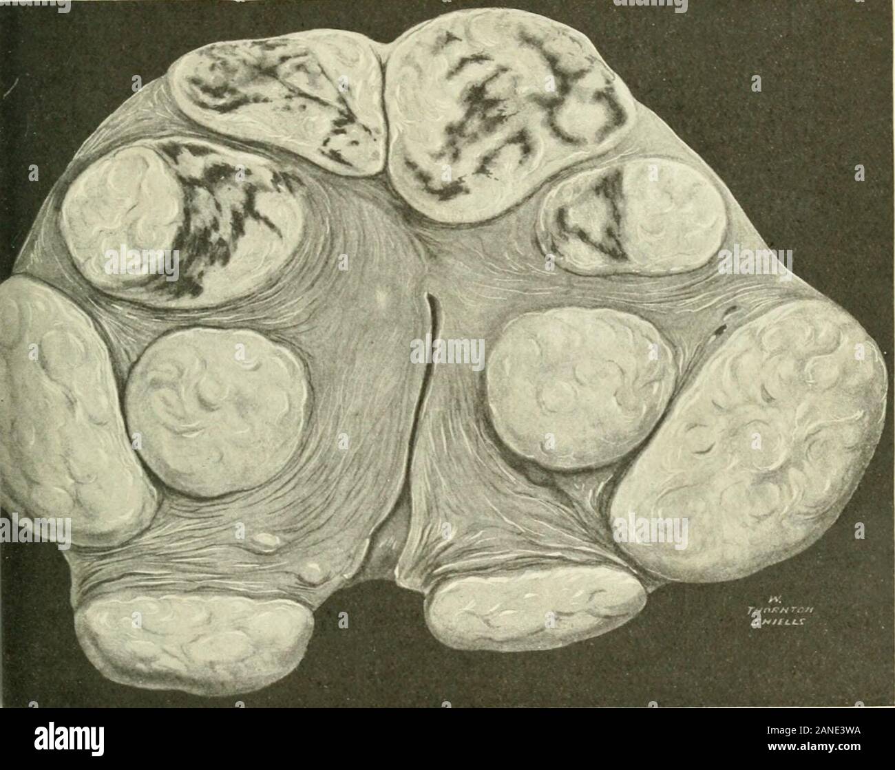Fibromi e allied tumori (mioma e adenomyoma) : la loro patologia, caratteristiche cliniche e trattamento chirurgico . La figura 92. Stessa sezione come visto sopra, mostra piccoli endotheliallymph-spazi in aree di ialina (X 4). F.ACE IO-ETÀ 79 INFEZIONE 79 per mostrare come quattro) mostrano aree scure di telangiectatic cambiamento. Figu re 91, Piastra XXIV., mostra una condizione telangiectatic associato con un lymphangiectatic sviluppo in un mioma. In figura 92, la piastra XXIV., si vede la diapositiva microscopica (ingrandito quattro volte) dalla quale la figura 91 è stata attirata ; esso. Fig. 9c.-mostra telangiectatic aree in miomi. Il colore ha b Foto Stock