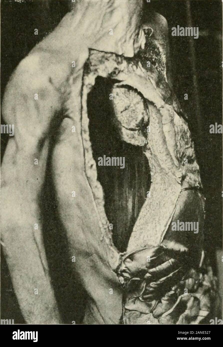 Malattie del torace e i principi di fisica diagnosi . es sembra migliore di considerarla come una malattia distinte.Inoltre, è di solito secondario a condizioni in cui dal veryonset, vi è una decisa tendenza alla formazione di pus. 590 malattie di bronchi e polmoni, alla pleura, e diaframma eziologia.-l'organismo che più frequentemente provoca la conditionis lo pneumococco. Nei bambini la percentuale è molto alta. Strep-tococci rango successivo in importanza. Una serie di studi che hanno beenmade della batteriologia di empyemata mostra che da metà a due terzi del numero CAS Foto Stock