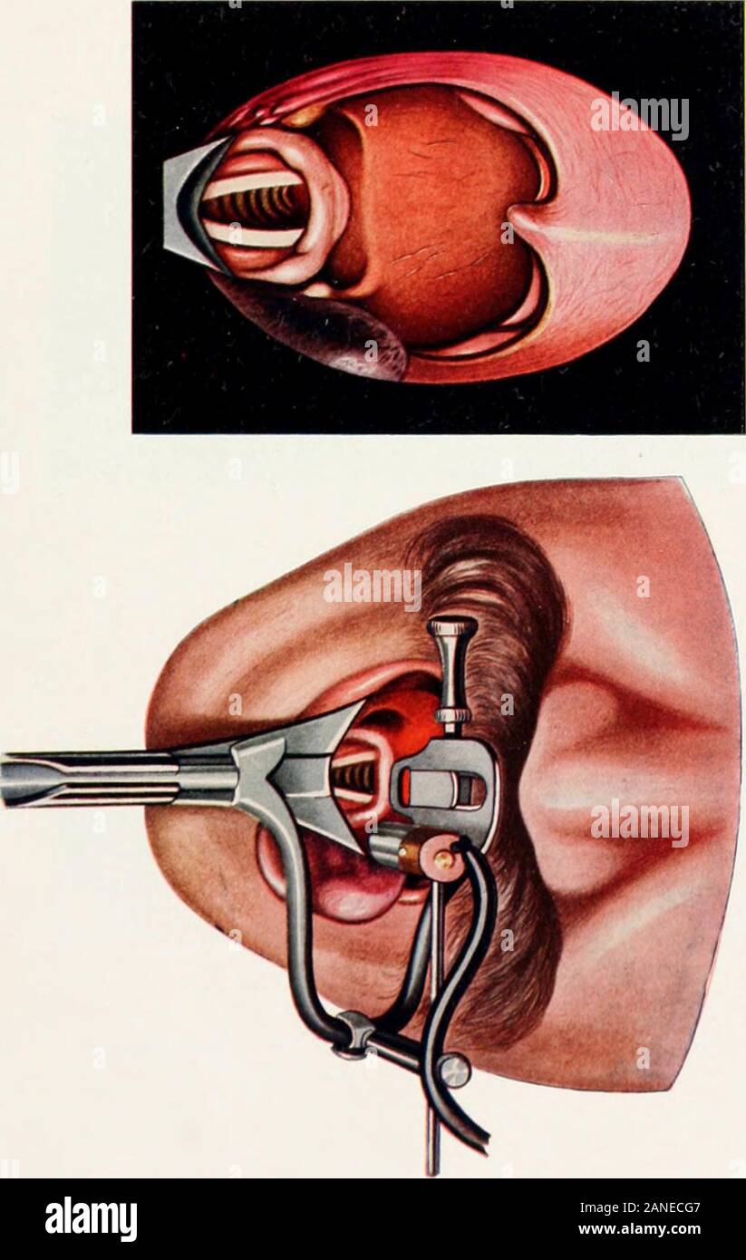 Endoscopia perorale e chirurgia laringea . Hays.) B, carcinoma della minore cuvalure. (Patientafterward chirurgicamente esplorato e la diagnosi verificata dal Dottor Giovanni J.Buchanan.) C, guarito i)ulcera erforated (paziente di cui dal dottor JohnW. Boyce). Illustrazione Lozver. Disegnata da un caso di post-diphtheritic sub-apnee stenosi indurito mediante il metodo di autori di diretta galvano-cauteriza-zione del ipertrofie. A immediatamente dopo la rimozione del intuba tion tubo, ipertrofie turbinals simili sono visti sporgenti nel sub-apnee lume. B, cinque minuti più tardi. Le masse sono ormai chiuse thelumen quasi Foto Stock