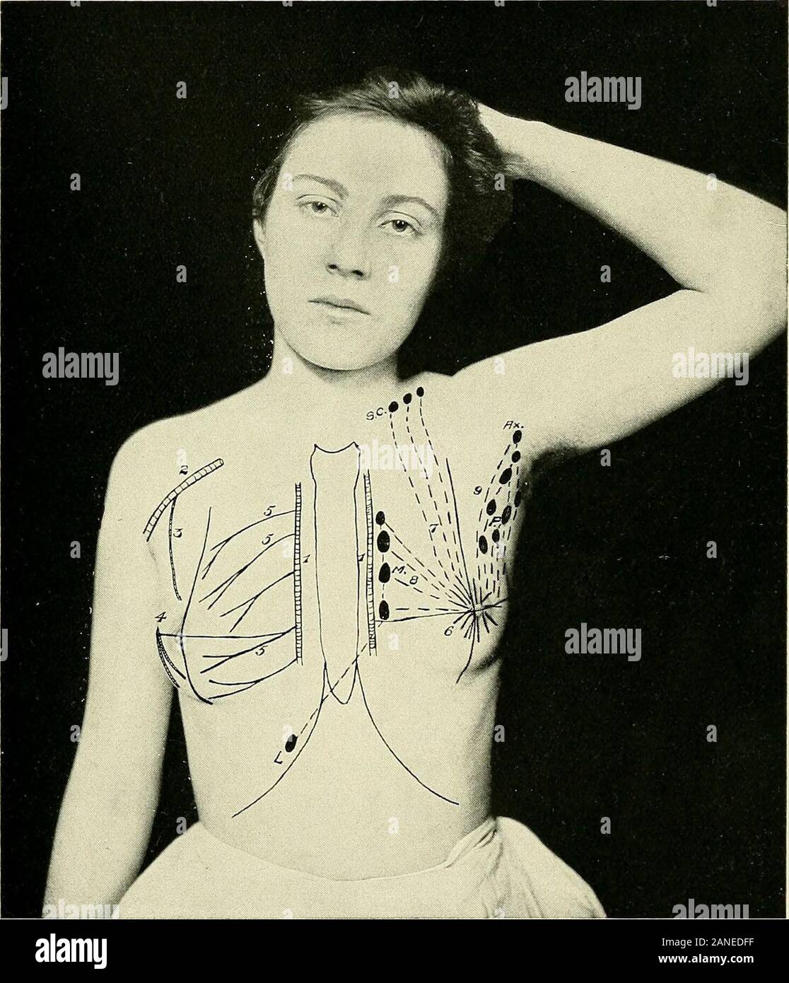 Un libro di testo di anatomia clinica : per studenti e professionisti . vuoto nell'ascella e (2) il più profondo, whicharise da porzioni più profonde e passare attraverso le nervature nell'theanterior mediastino. Il numero maggiore appartengono al superficialand vuoto o in un insieme di ghiandole lungo il bordo inferiore del thepectoralis principali (a volte primo interessato), o nell'ascellare e sovra-clavicular ghiandole (Fig. 62). La profonda i linfatici vuota in un setalong l'arteria mammaria interna. Questo spiega perché le infezioni cantravel attraverso il torace, o anche per il fegato (dove metastasesafter carcin Foto Stock