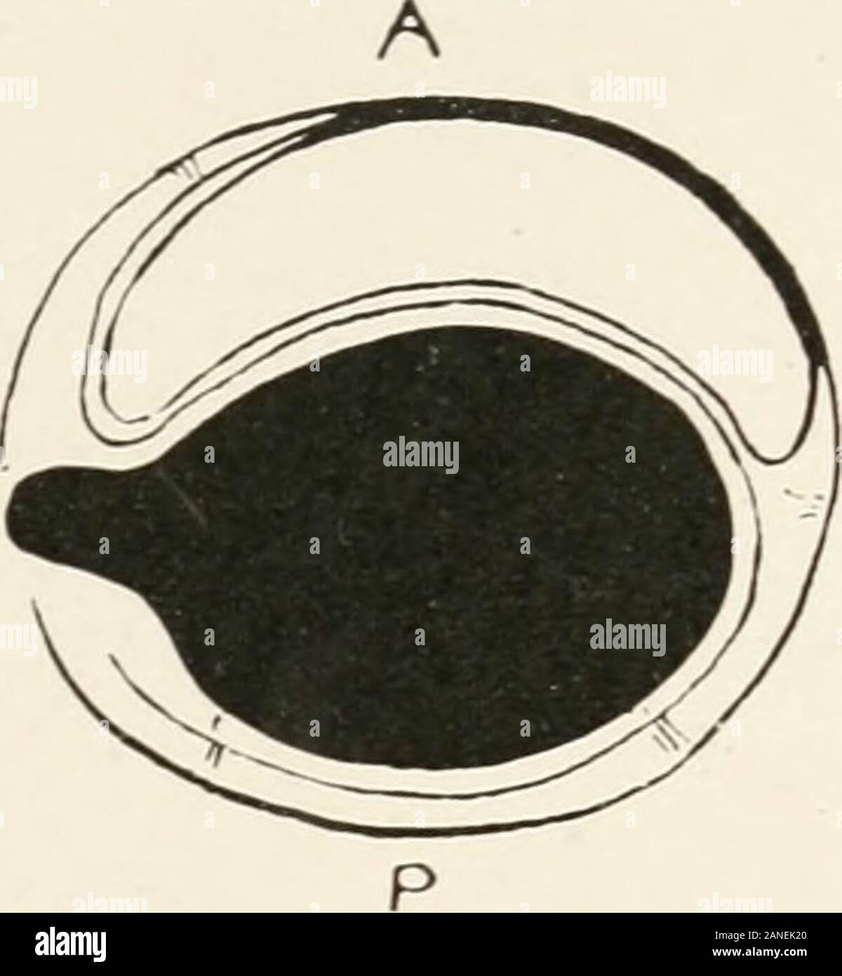 AMAarchives di Neurologia e psichiatria . d uno dopo l'operazione. In quest'ultimo (caso 5) FRAZIER-SPILLERSPIXAL tumore cavo 467 il tumore era situato nel quartiere del settimo andeighth cervicale e toracica prima radici; infatti, il settimo cervicalroot passò oltre la metà del tumore. Sudorazione nel lato destrodel il volto a volte è stata segnata e oculare phenomenawere simpatico anche notato. Questi fenomeni devono essere state traumatiche, inci-dentale per la rimozione del tumore. In altri casi non vi era quasi costante la sudorazione, anche incold meteo, oltre la giusta orbita. Il tumore è stato sit Foto Stock