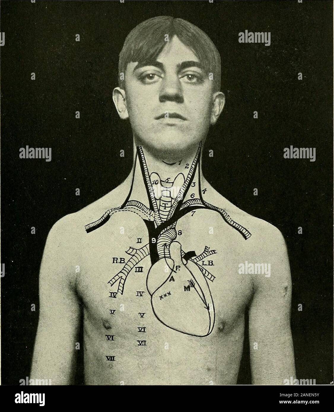 Un libro di testo di anatomia clinica : per studenti e professionisti . ultimo passa verso l'alto, quindi transverselyacross alla trachea, passando tra la guaina carotidea e vertebralartery (vedere figg. 31 e 38). Vertebrale passa al transverseprocess della sesta vertebra cervicale, accompagnato dalla vena. Itcan essere raggiunta da una incisione lungo il bordo posteriore della sterno-cleidomastoid, tirando la guaina carotidea verso l'interno e la dissezione di downtown il processo trasversale della sesta vertebra cervicale (vedere Fig. ^^j. Cervicali profondi scudo.-Si è già visto che lo strato esterno inizia nel medi Foto Stock