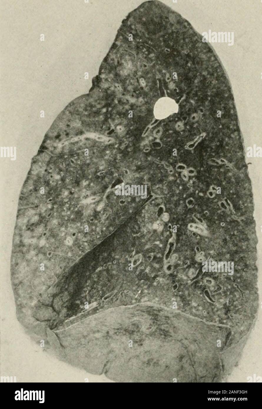 Malattie del torace e i principi di fisica diagnosi . eumococci (comunemente tipo IV),che si immettono nel polmone e produrre o bronco- o lobar-pneumoniaand (3) una invasione terziario da streptococchi (o emolitica non emolitico)che infettano le aree pneumonic.-(Opie, Freeman Blake, piccola andRivers, Camp Pike polmonite Commissione.MI) In alcuni casi la1 Jour. Am. Med. Assoc, 22 febbraio, 1919. 444 malattie di bronchi e polmoni, alla pleura e il diaframma, pneumococchi non giocano alcun ruolo, gli streptococchi essendo l'invasore secondario.In altri casi l'invasore secondario possono essere staphylococcusor Foto Stock