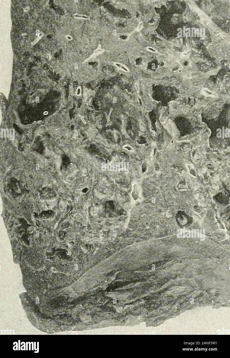 Malattie del torace e i principi di fisica diagnosi . Fig. 283.-Extreme dilatazione dei bronchi e ammorbidenti dei tessuti polmonari. Pike polmonite commissione.) {Camp numero di casi che sono stati attentamente studiati vi sembra essere afairly sequenza precisa degli eventi: (1) una infezione primaria del tratto upperrespiratory e dei bronchi dall'aviaria bacillus; (2) un secondaryinvasion dei bronchi infiammati da pneumococchi (comunemente tipo IV),che si immettono nel polmone e produrre o bronco- o lobar-pneumoniaand (3) una invasione terziario da streptococchi emolitici (o non-hemoly Foto Stock