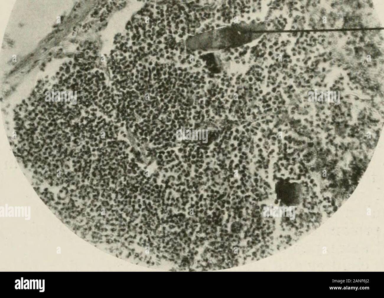 Malattie del torace e i principi di fisica diagnosi . Fig. 276.-fibre di carne (a) bronco-pneumonic focus. (Dott. F. D. Weidman.) i bambini che sono debilitati come il risultato di sifilide, rachitismo o diar-rhea sono estremamente soggetti a bronco polmonite e bambini livingamidst insanitary dintorni e i detenuti di manicomi orfani o trovato-hng case sono particolarmente inclini a sviluppare la malattia. In quanto la bronco polmonite spesso si sviluppa come un sequel toacute bronchite, malattia di solito è più prevalente durante il winterand primi mesi primaverili. In questo momento le infezioni respiratorie una Foto Stock