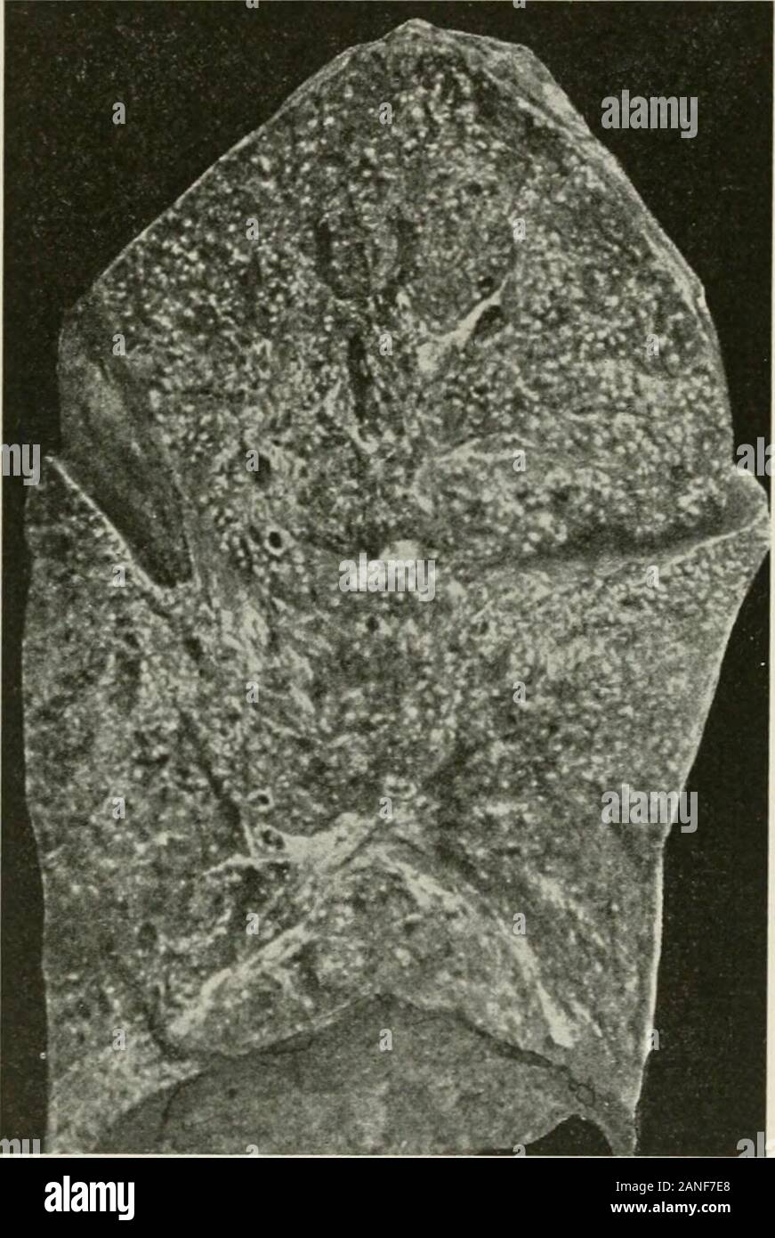 Malattie del torace e i principi di fisica diagnosi . e di solito aumenta di dimensioni. I polmoni sono più grandi del normale e intensamente hyperemic. Il sec-zione della superficie di taglio appare di colore rosso scuro e granulare e i noduli feelhard. Quando la condizione è secondario alla polmonare cronica di tubercu losis dei polmoni negli adulti i noduli sono meno nettamente definito e tendto coMfesce. I noduli sono sempre più numerose in immediateneighborhood originale del focus e tendono a diminuire in numero come 382 malattie di bronchi e polmoni, alla pleura e il diaframma, la base del polmone è raggiunto. In Foto Stock