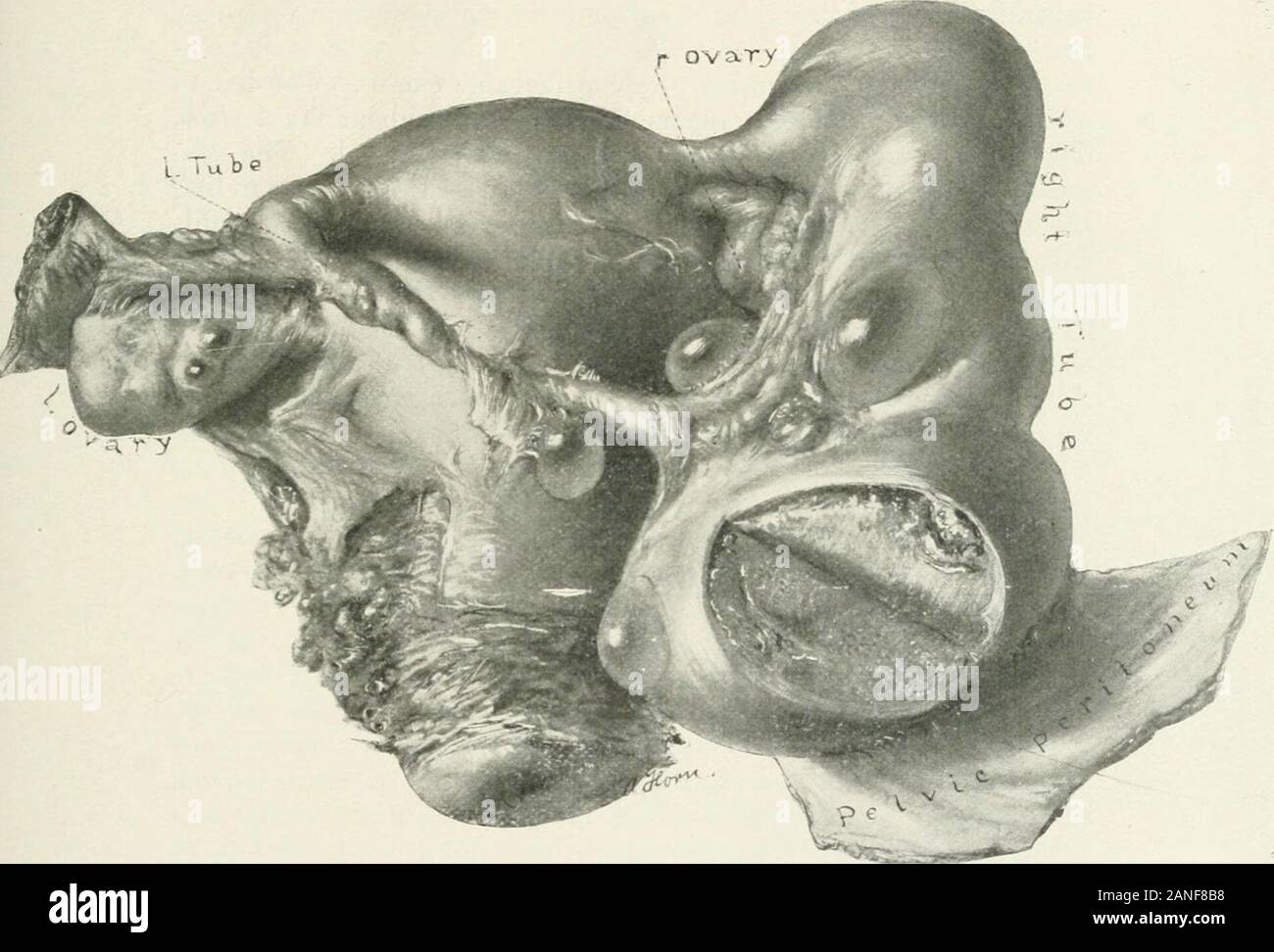 Il canadese ufficiale di medicina e chirurgia . g e ha dato la sua oltre sei mesi di comfort di confronto. Gyn.-Path. ^o. 8114. Il campione comprende l'utero andenlarged tubo destro, entrambe le ovaie, il piccolo tubo di sinistra e un cuffof peritoneo pelvico, la maggior parte dell'omento e severalinches del retto. L'utero è stato rimosso completamente. Si tratta di 7 in 5 da 3.5cm. ed è coperto con numerose adesioni. Il cavityis uterino di dimensioni normali. La mucosa è più sottile rispetto al solito andshows nothinc di interesse. Canadian Journal di medicina e chirurgia. 29 Il tubo di destra in utero è di 3 mm Foto Stock